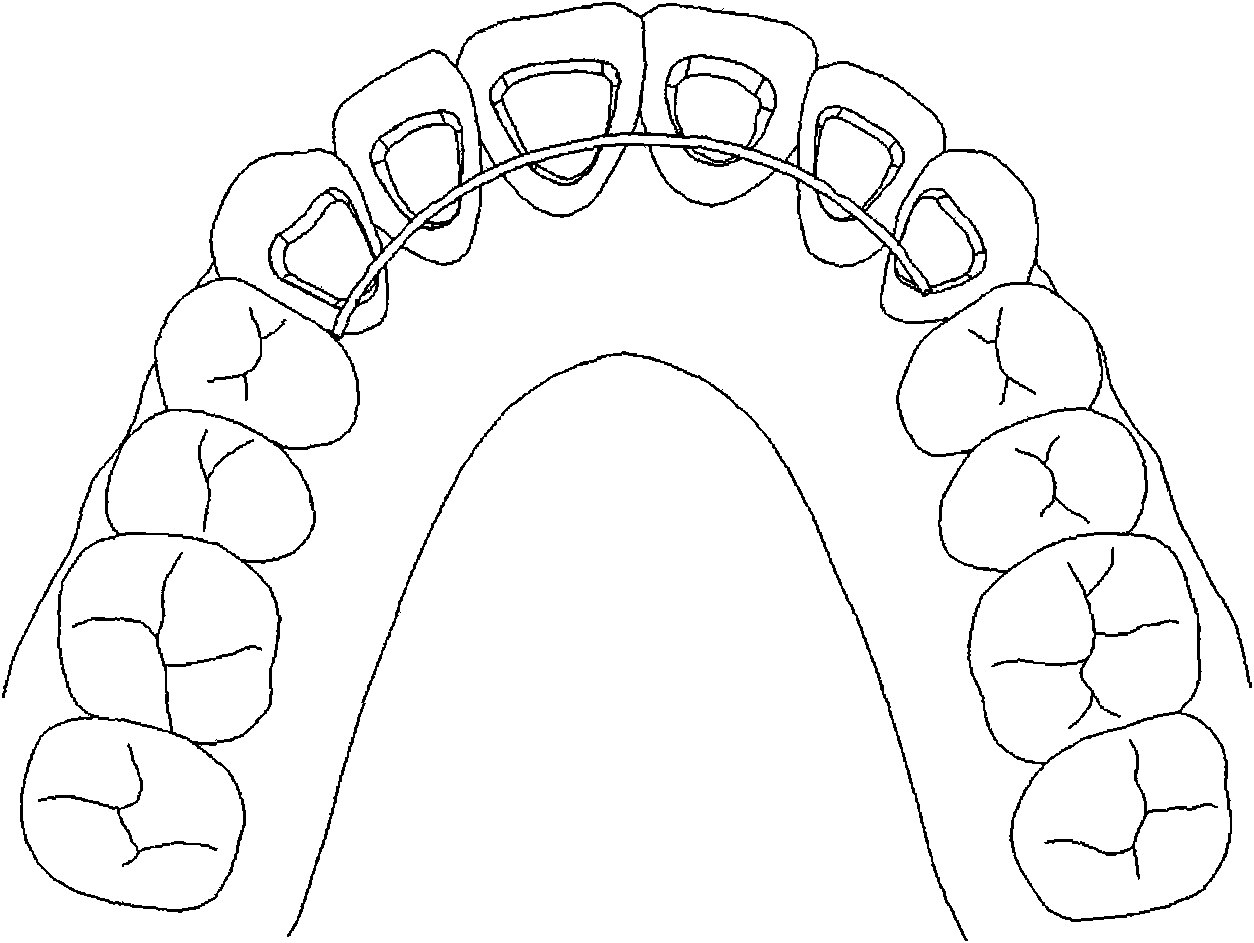 Manufacturing method of individual tongue-side orthodontic retainer