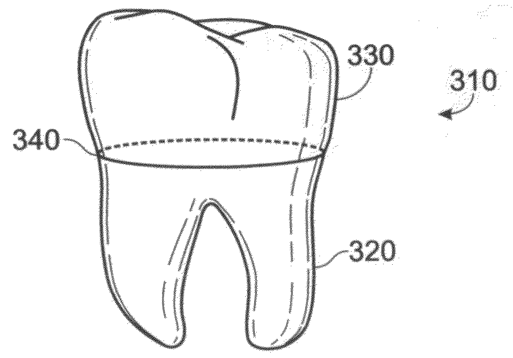 Dental implant fabrication and insertion methods and personalized dental implant for use therein