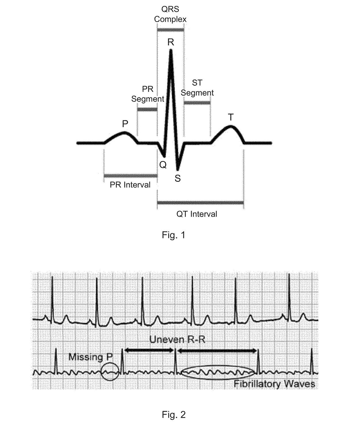 Method of detecting abnormalities in ECG signals