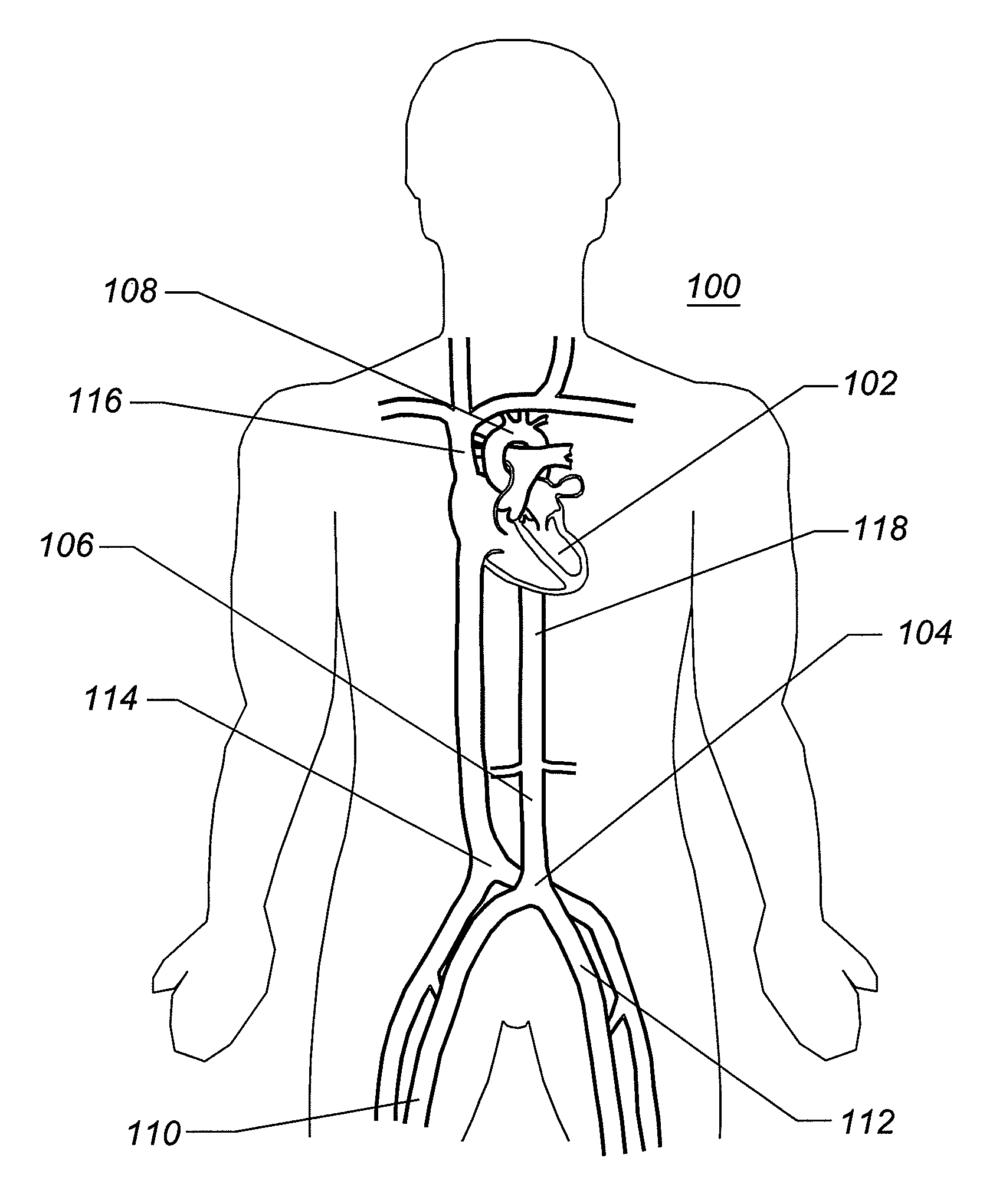 Expandable iliac sheath and method of use