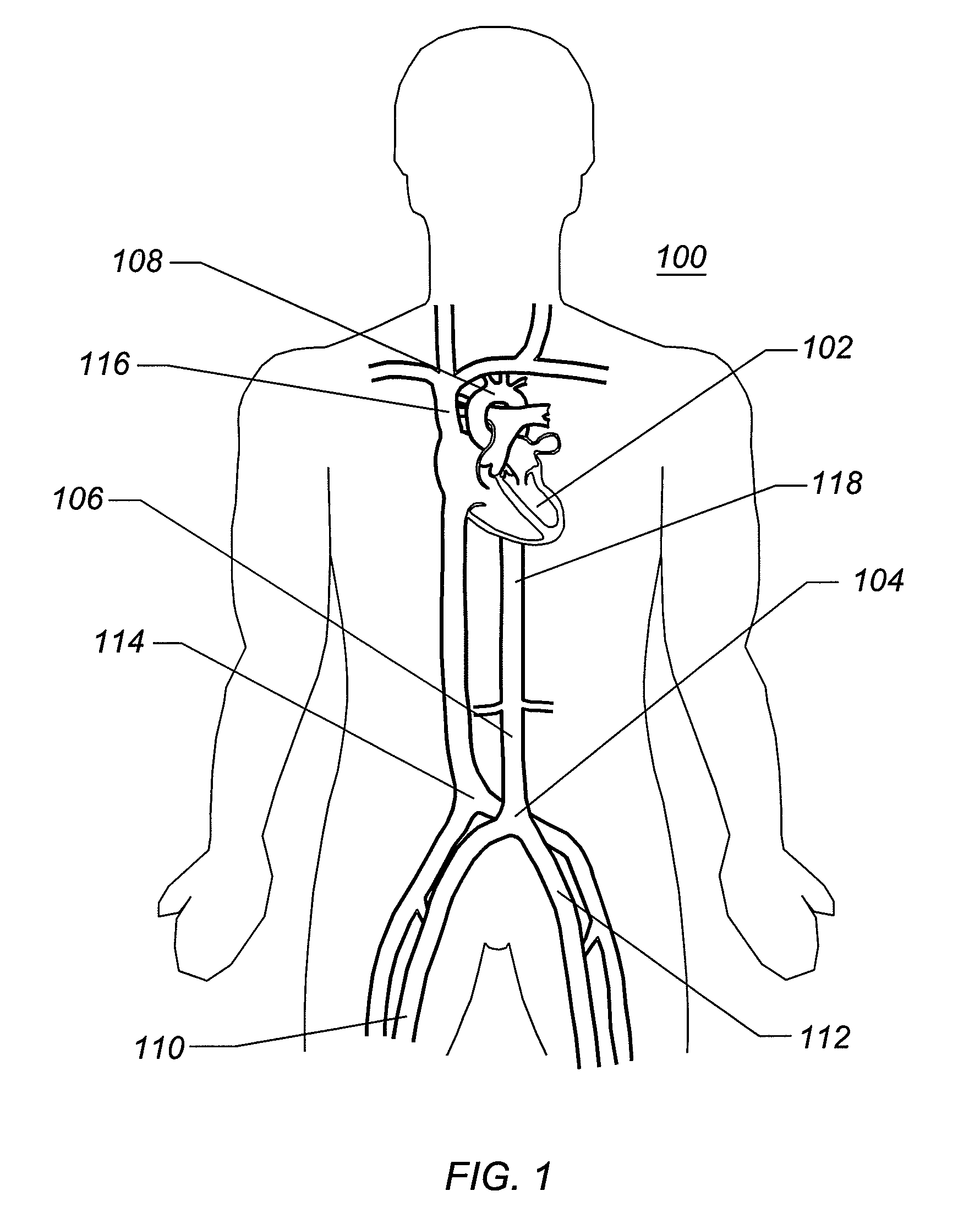 Expandable iliac sheath and method of use