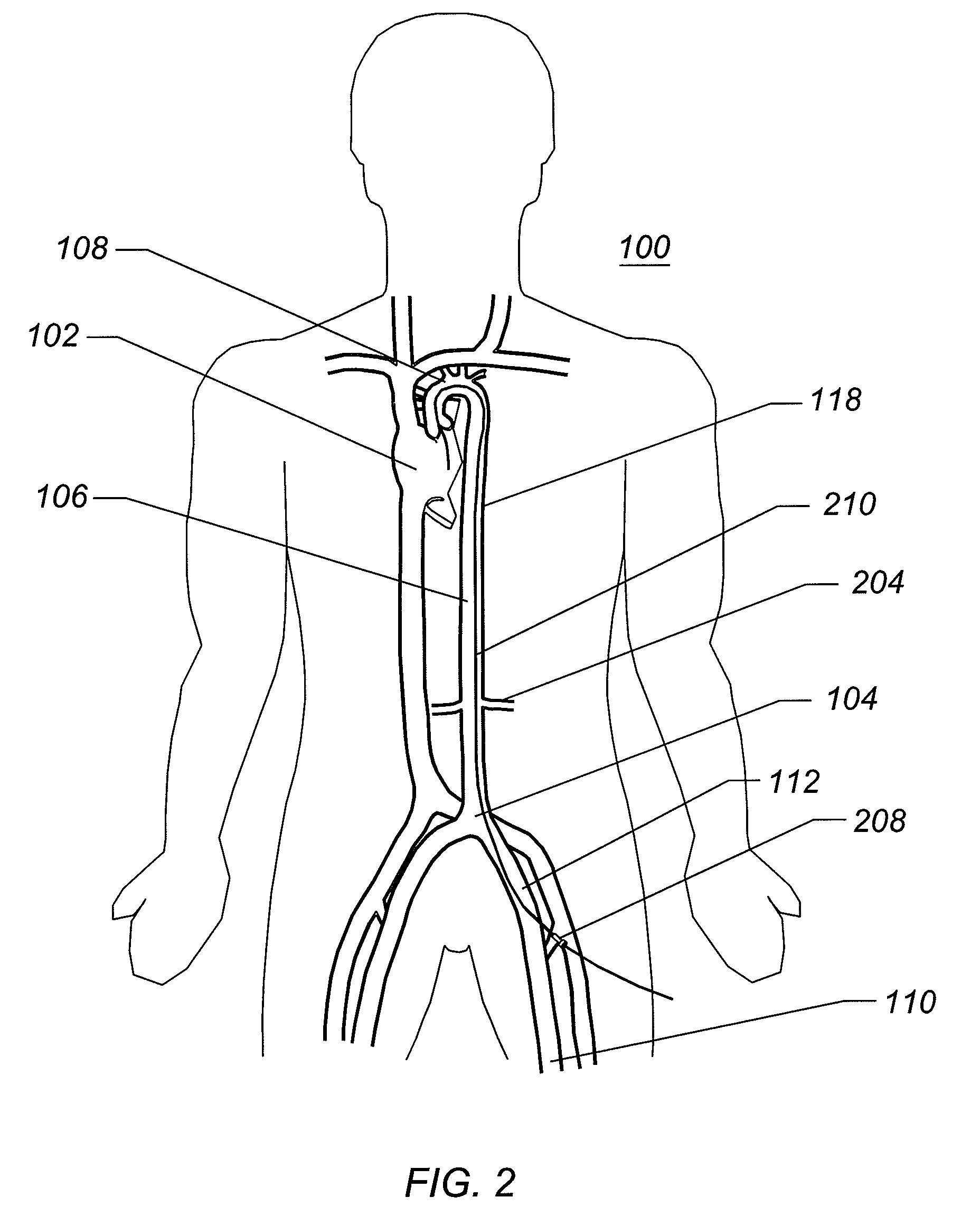 Expandable iliac sheath and method of use