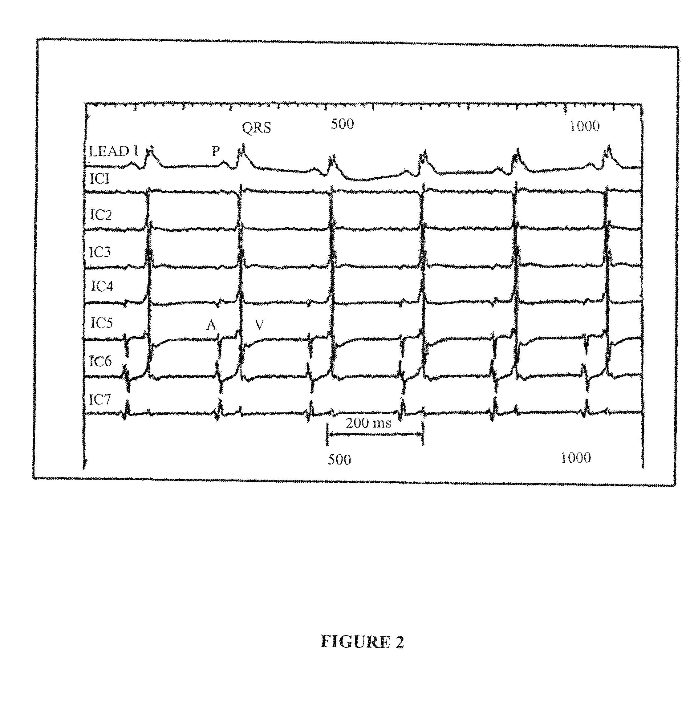 Electrocardiogram reconstruction from implanted device electrograms