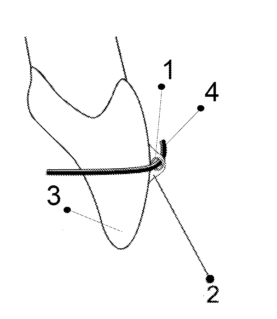Orthodontics System and Method of Use