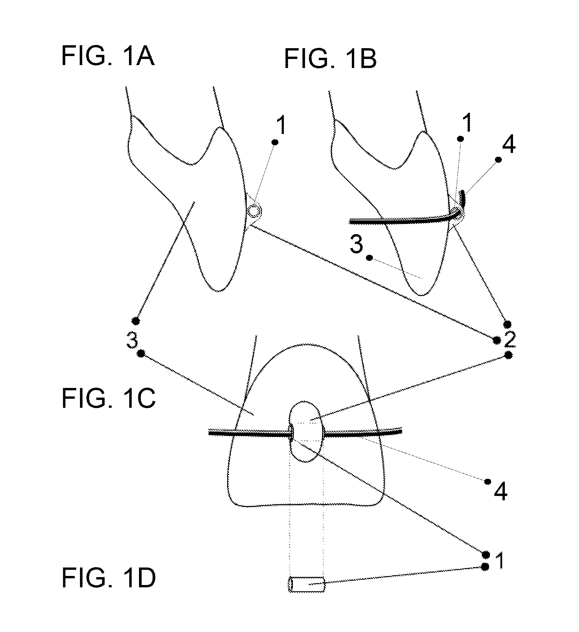 Orthodontics System and Method of Use