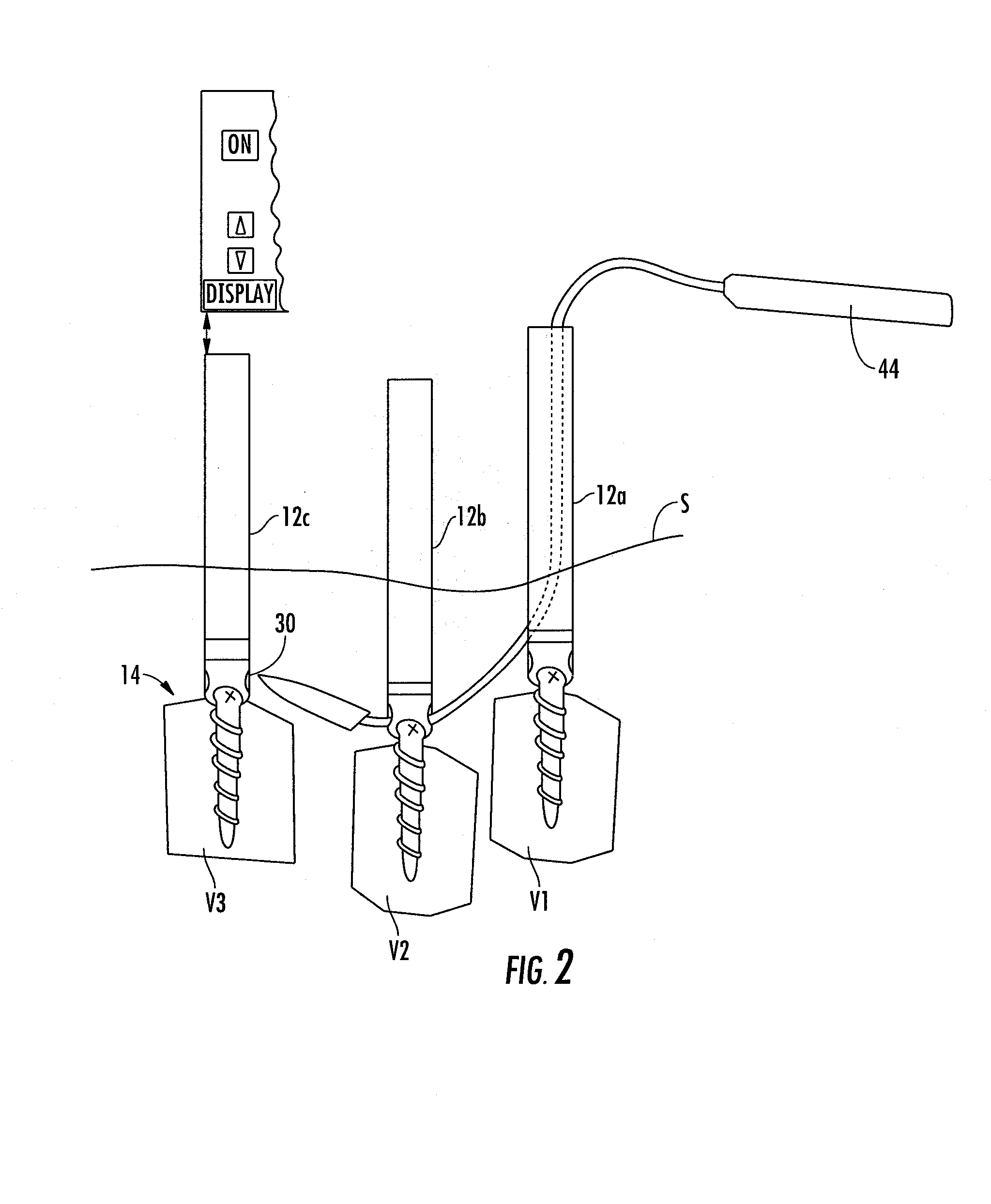 Method And Apparatus For Facilitating Navigation Of An Implant