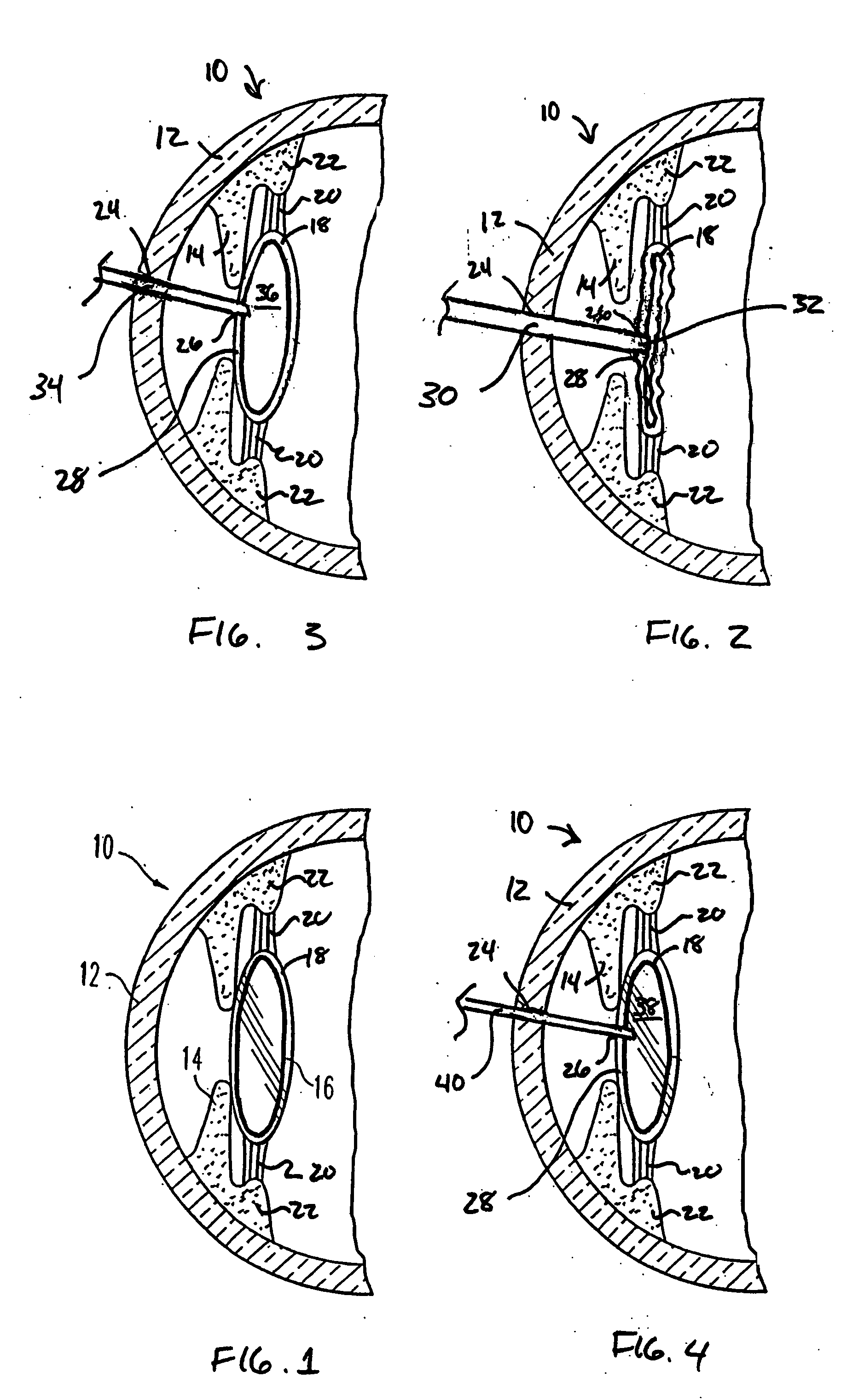 Adjustable intraocular lens for insertion into the capsular bag