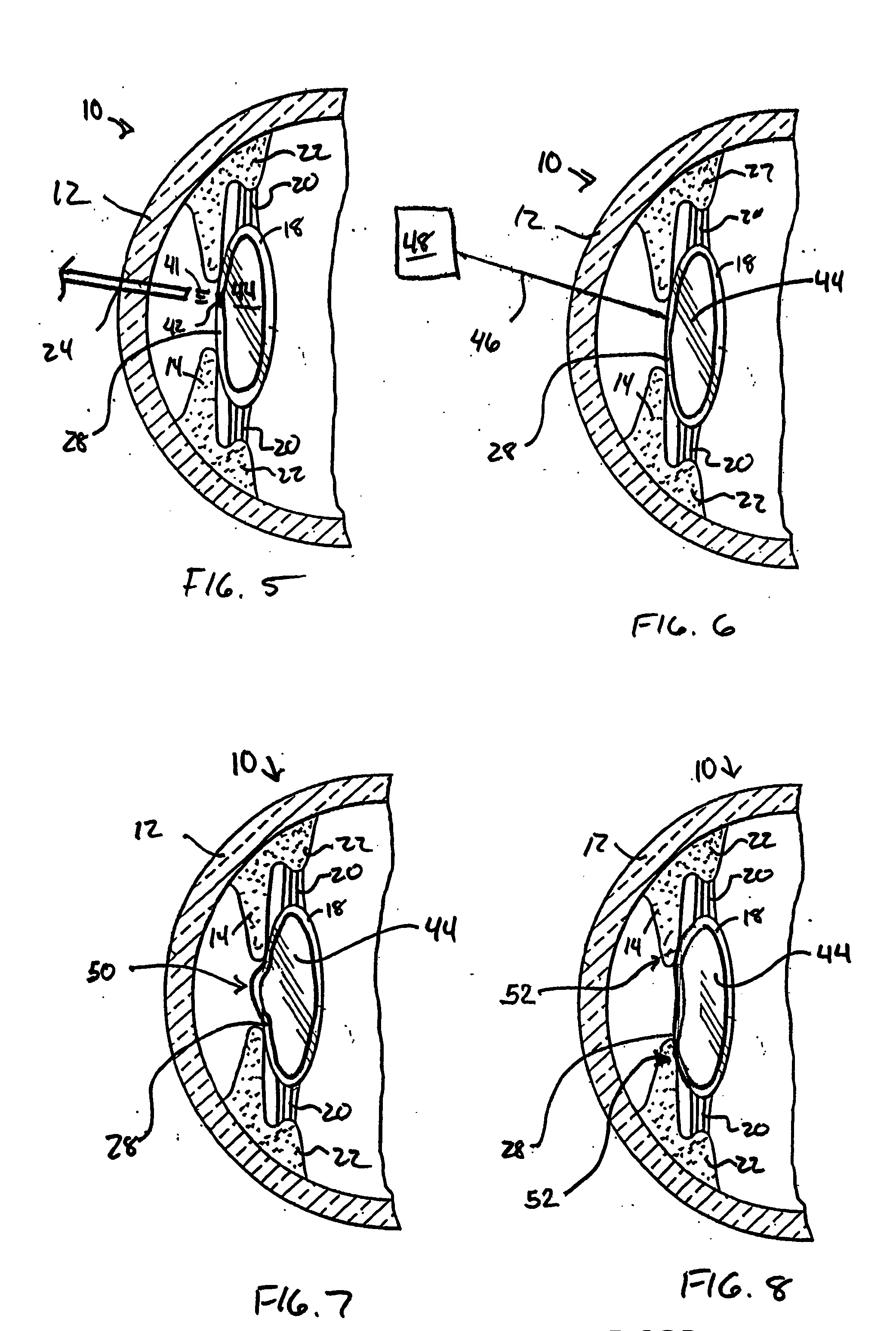 Adjustable intraocular lens for insertion into the capsular bag