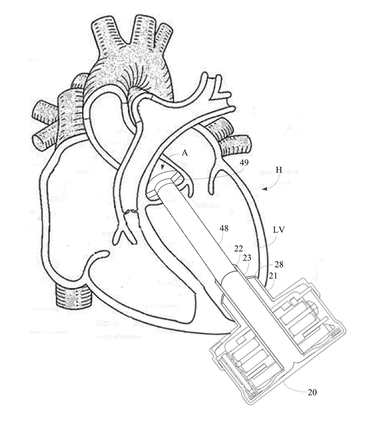 Implantable pump system having a coaxial ventricular cannula