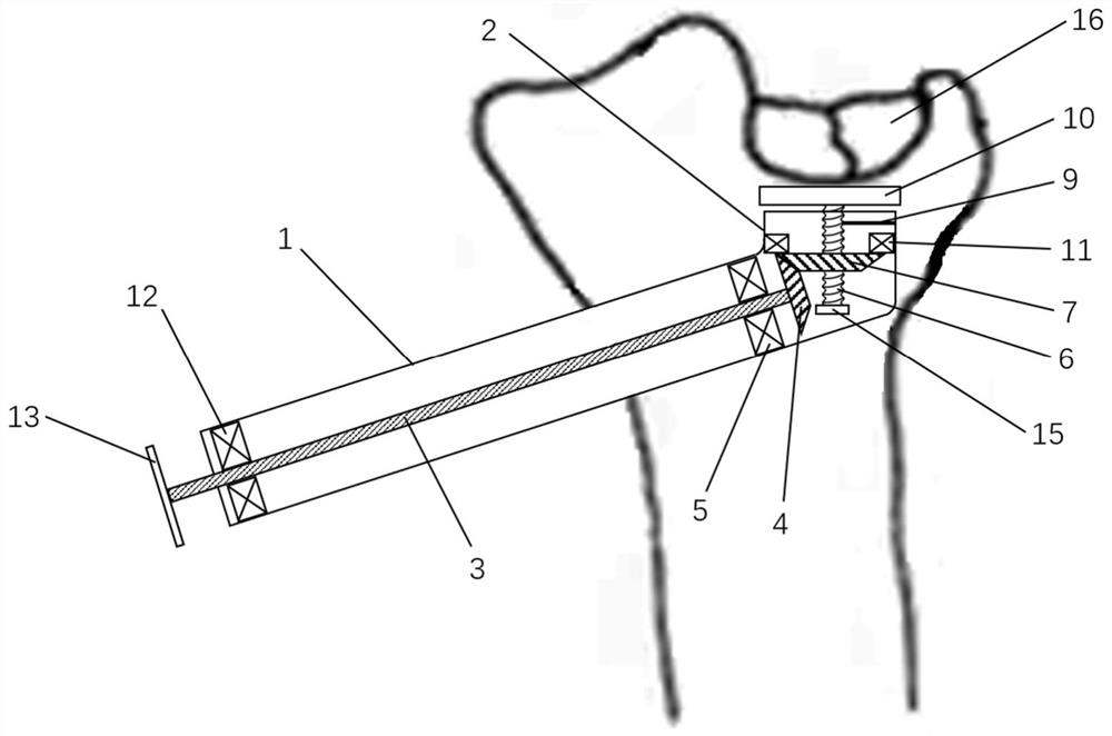 Vertically telescopic minimally invasive reduction device for tibial plateau collapse fracture blocks