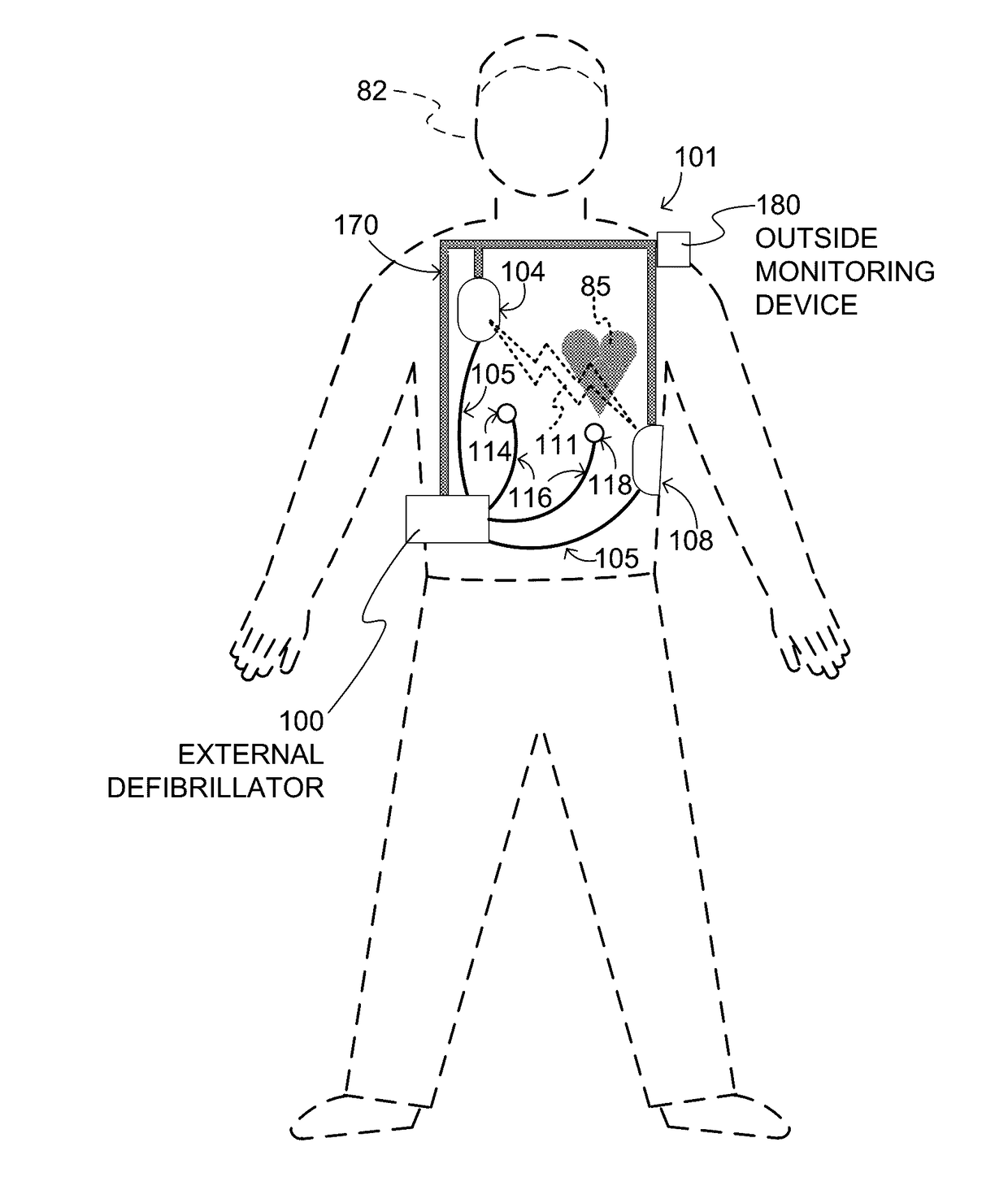 Wearable cardioverter defibrillator (WCD) system with isolated patient parameter component
