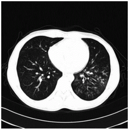 Low-dose CT image statistical reconstruction method based on discrete shear wave regularization