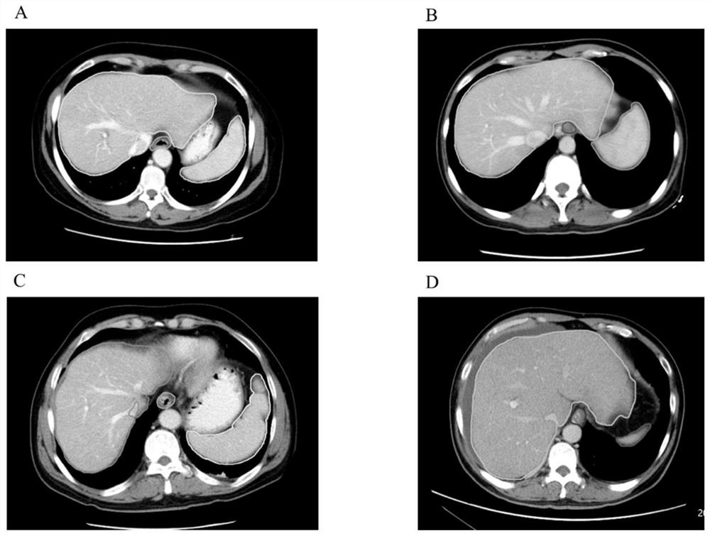 Enhanced CT (Computed Tomography) imageomics feature processing method for upper abdomen of liver cirrhosis patient and application thereof
