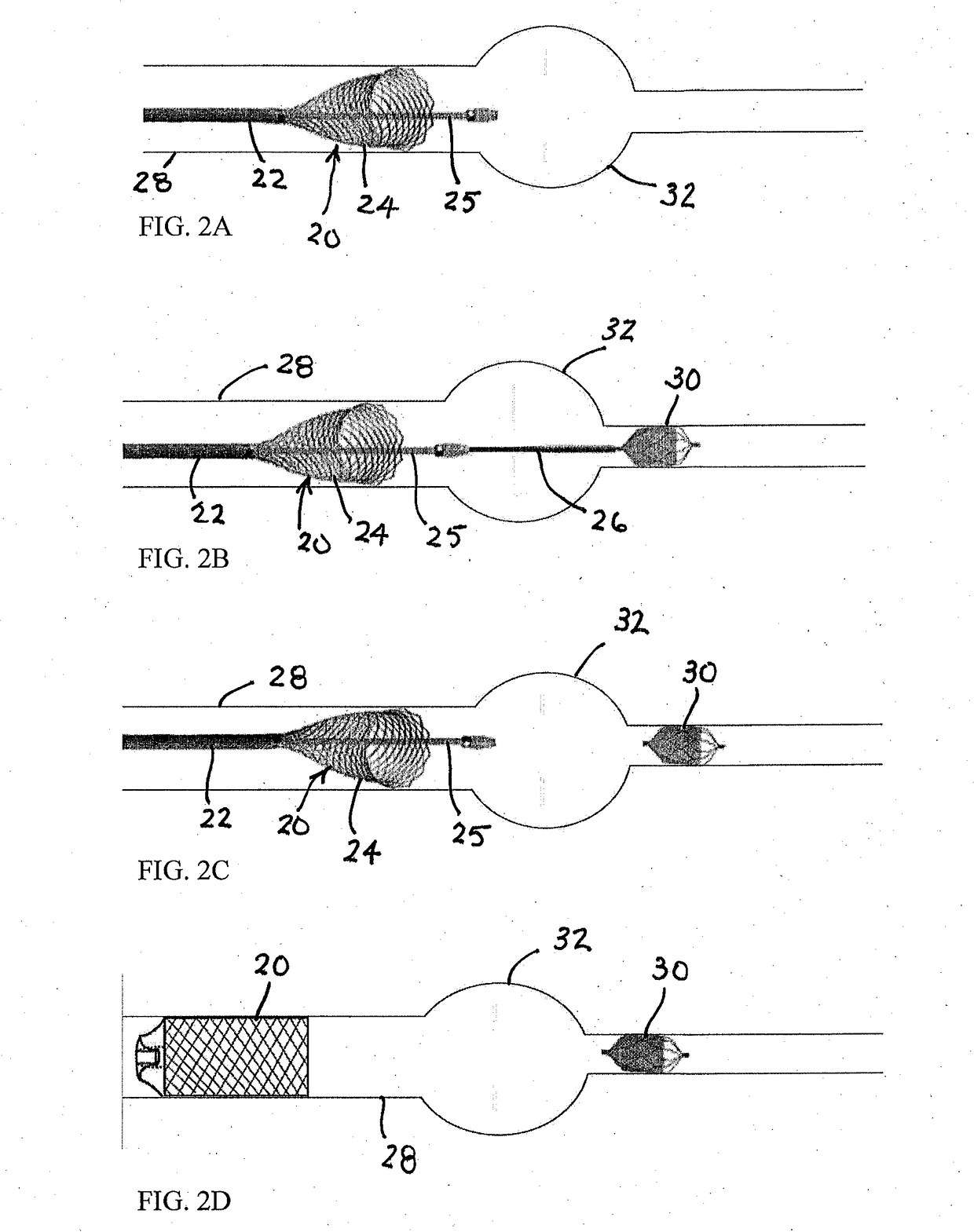 Endovascular occlusive device and associated surgical methodology