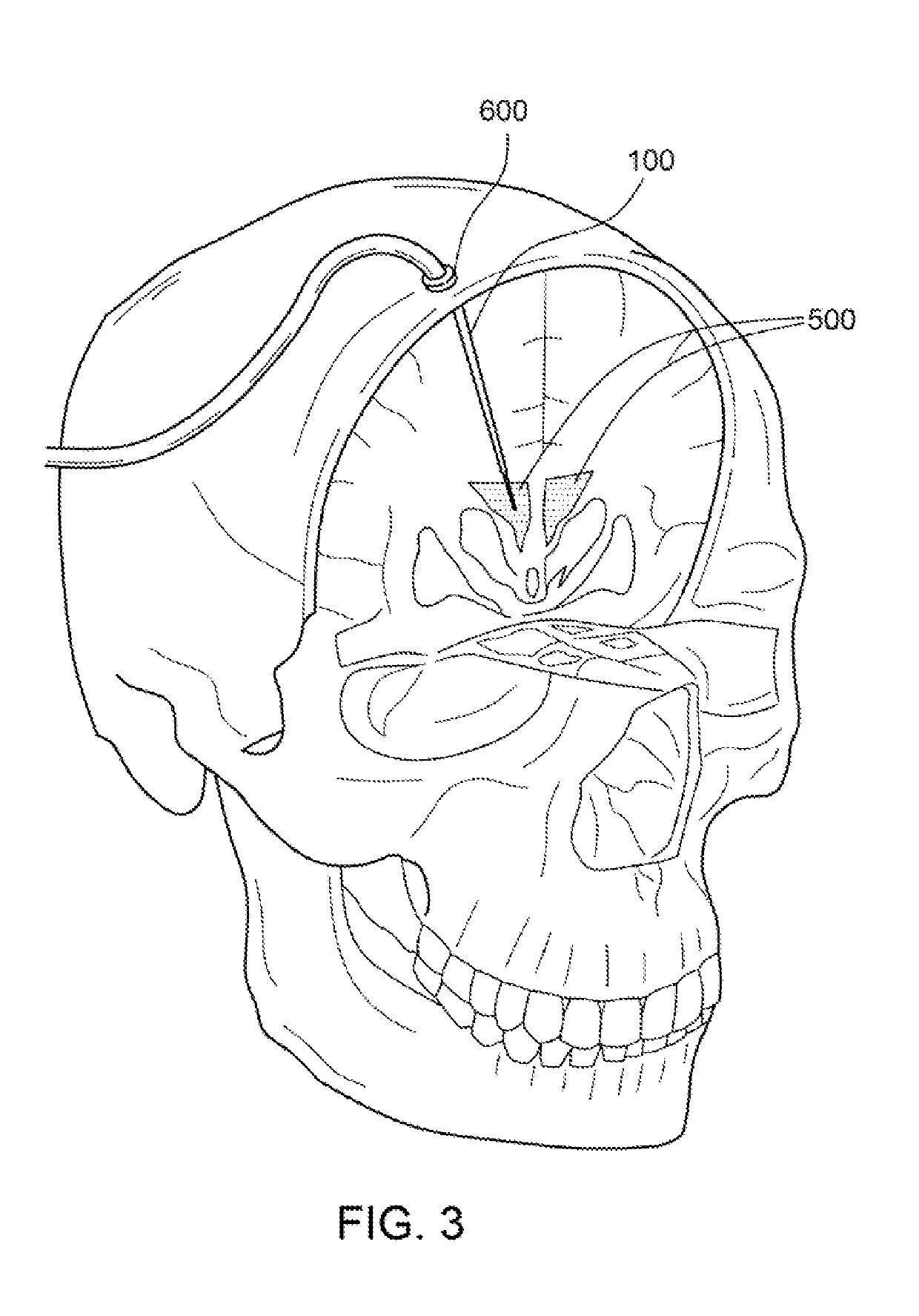 Cerebrospinal fluid cooling device