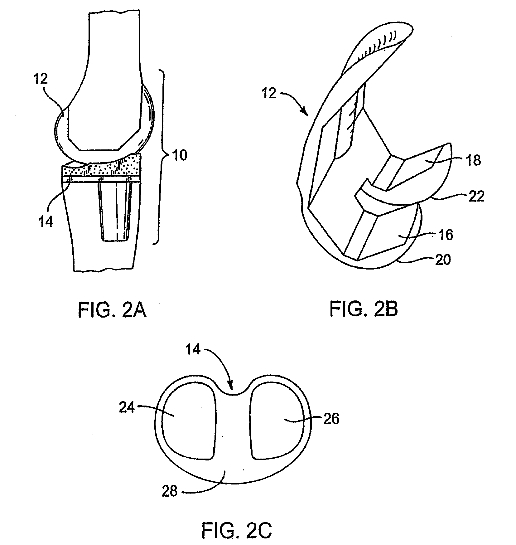Systems and methods for providing deeper knee flexion capabilities for knee prosthesis patients