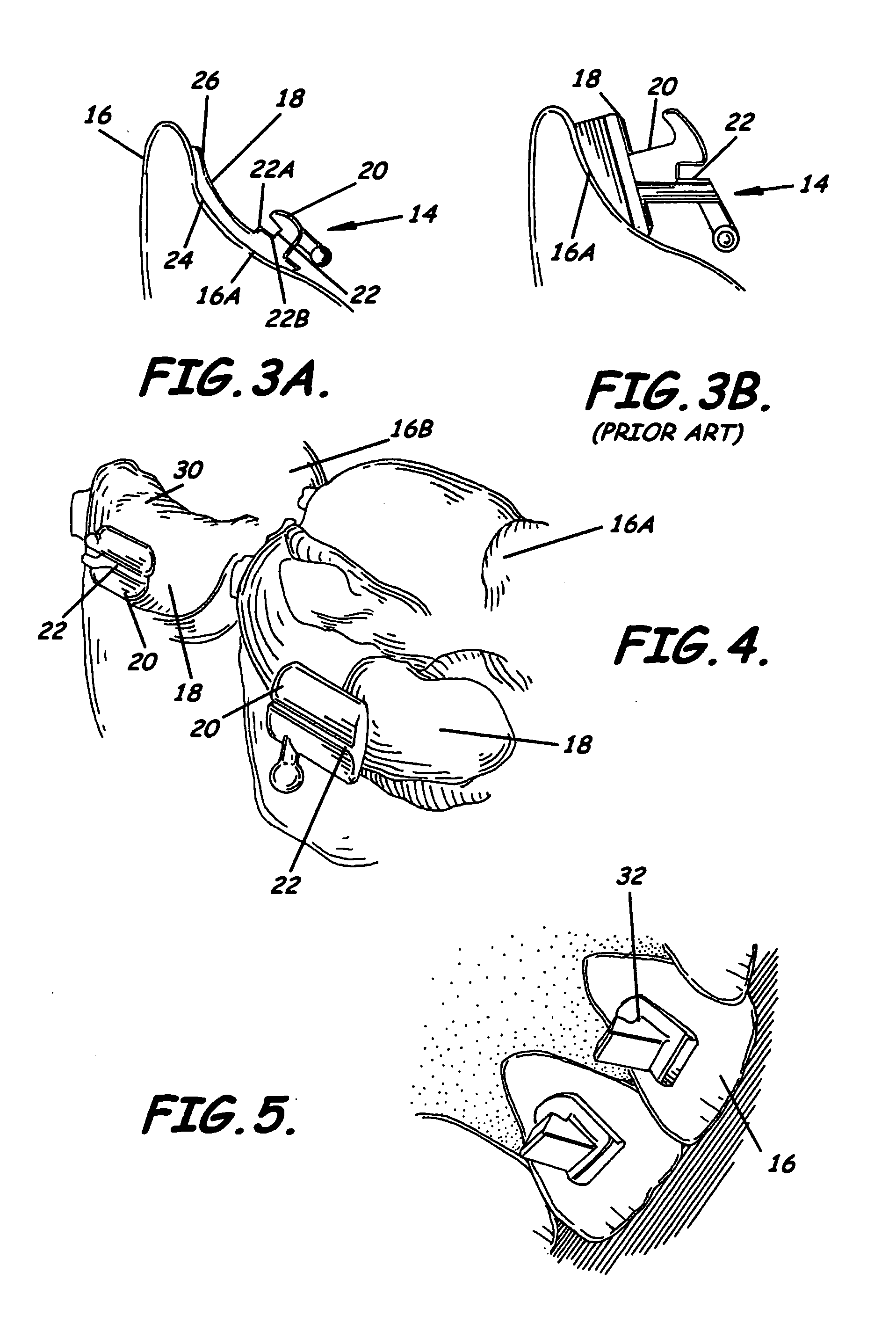 Modular system for customized orthodontic appliances