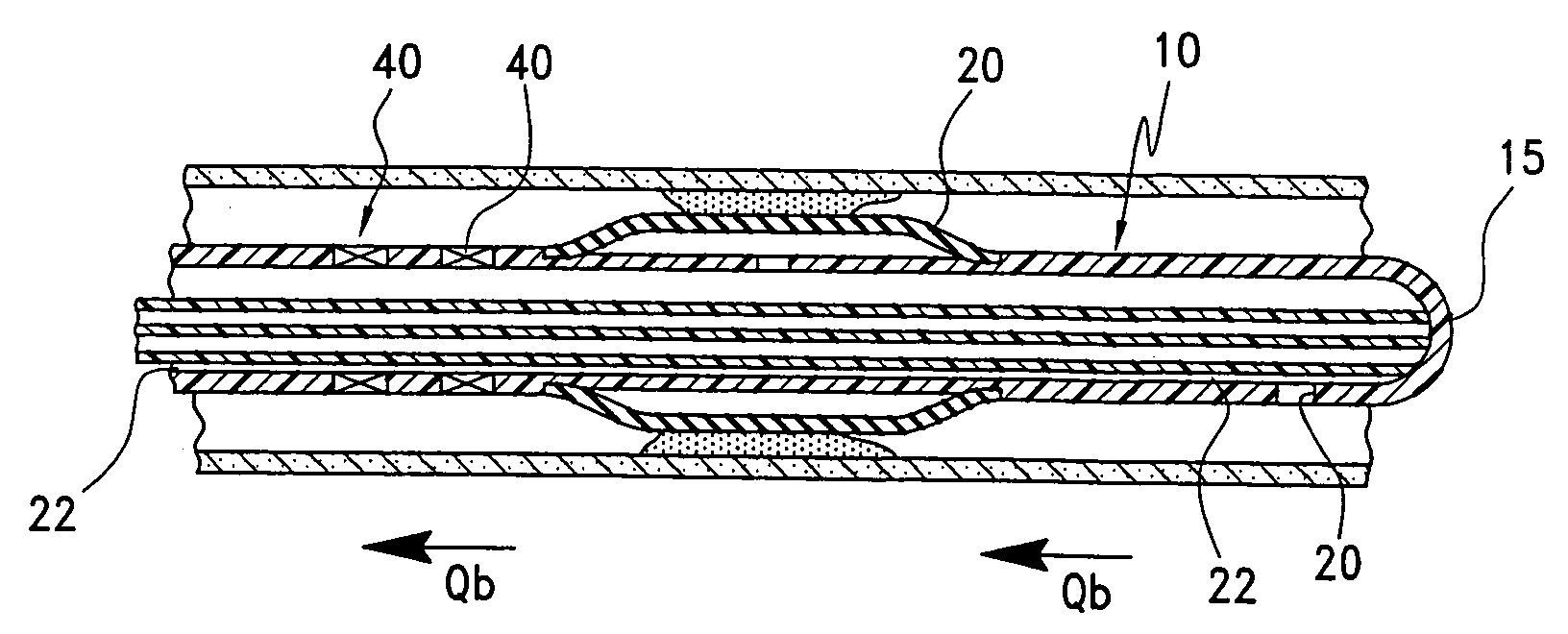 Method and apparatus for determining a blood flow during a vascular access dysfunction corrective procedure