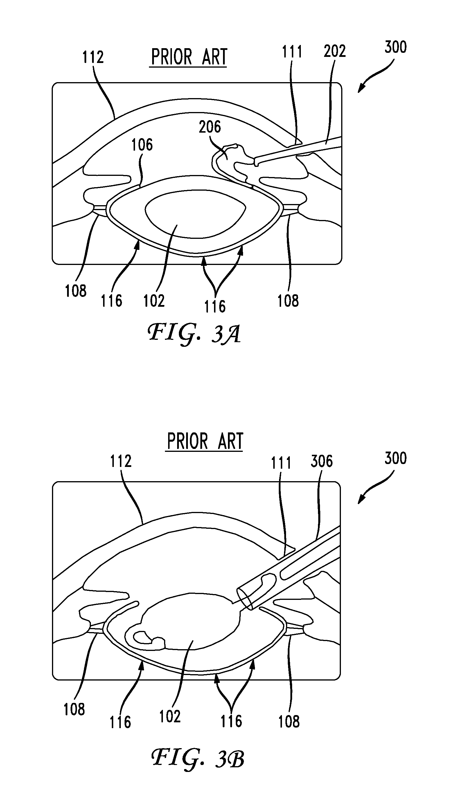 System and method of performing femtosecond laser accomodative capsulotomy