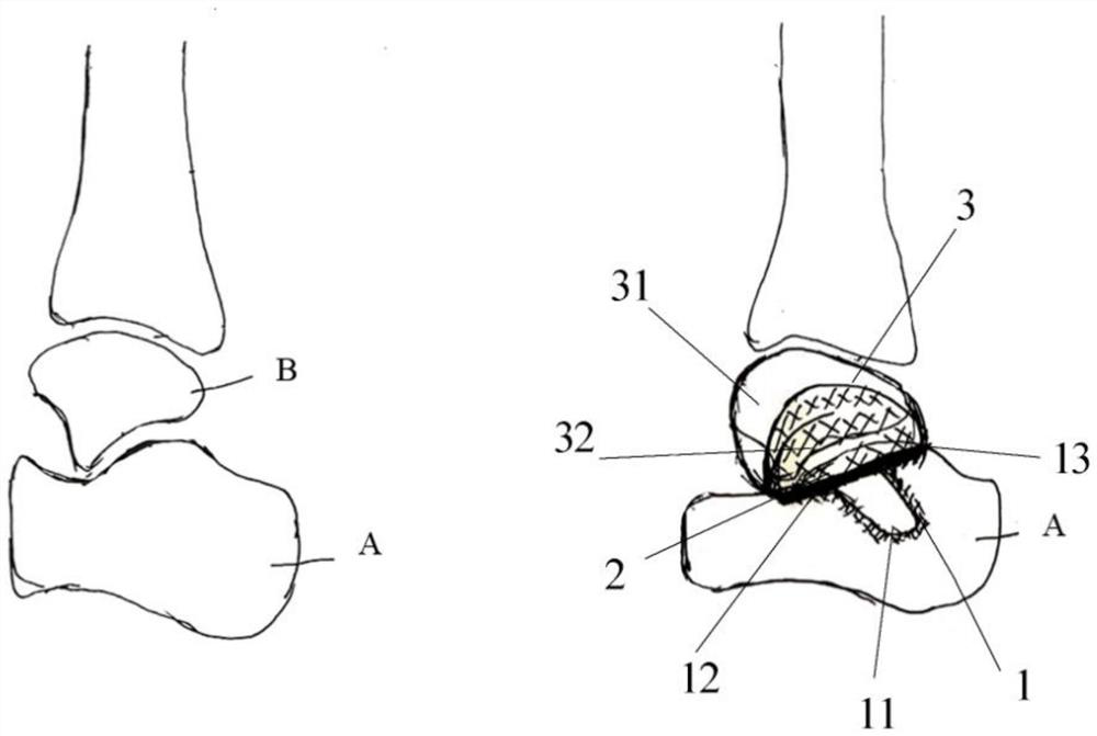 Porous metal and PEEK composite implanted joint prosthesis and preparation method