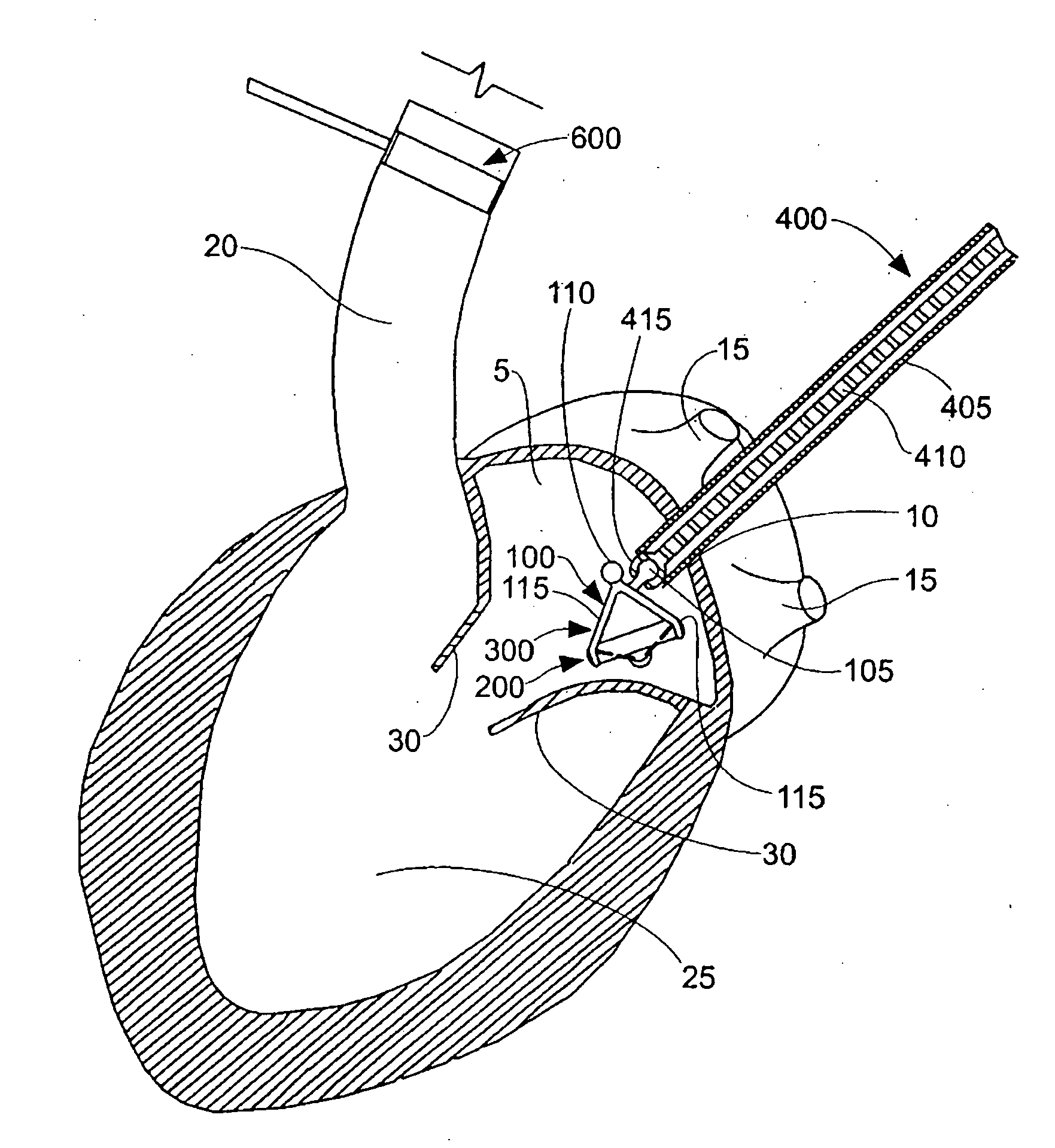 Method and apparatus for resecting and replacing an aortic valve