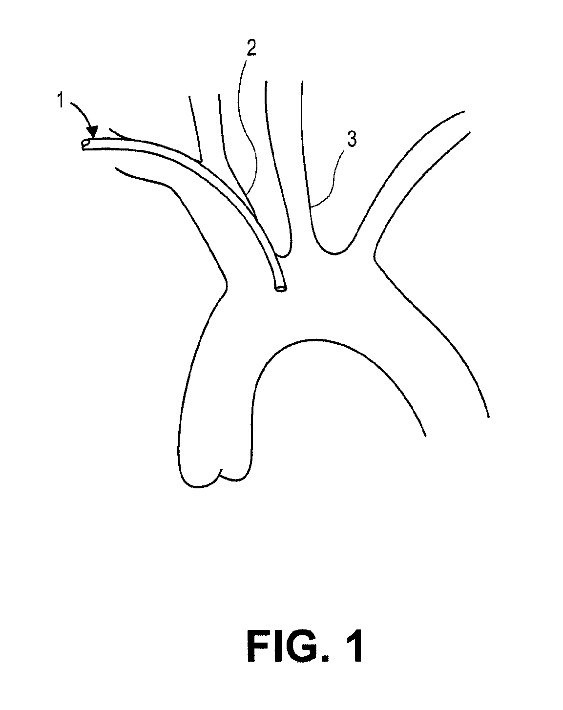 Intravascular blood filters and methods of use