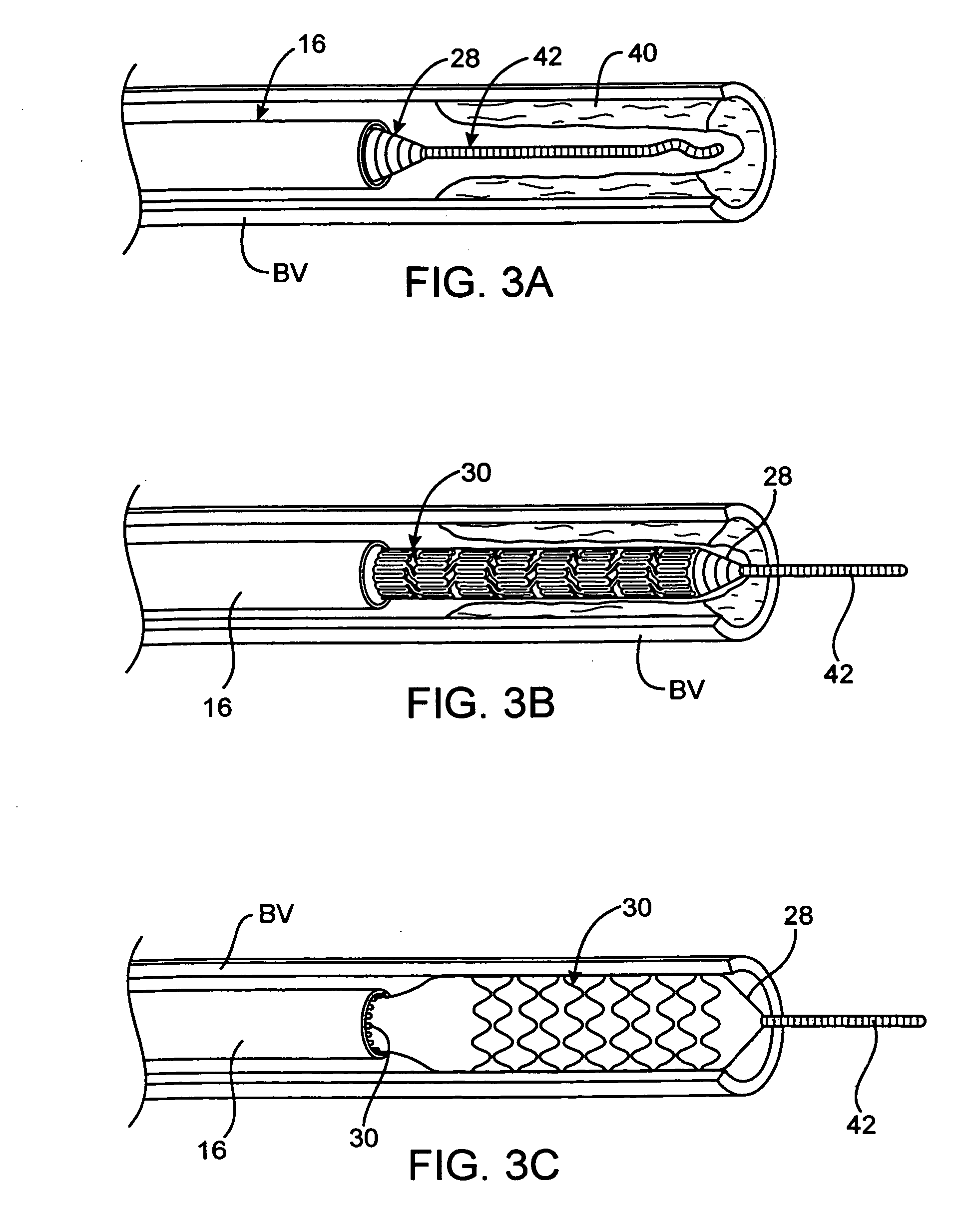 Apparatus and methods for delivery of multiple distributed stents