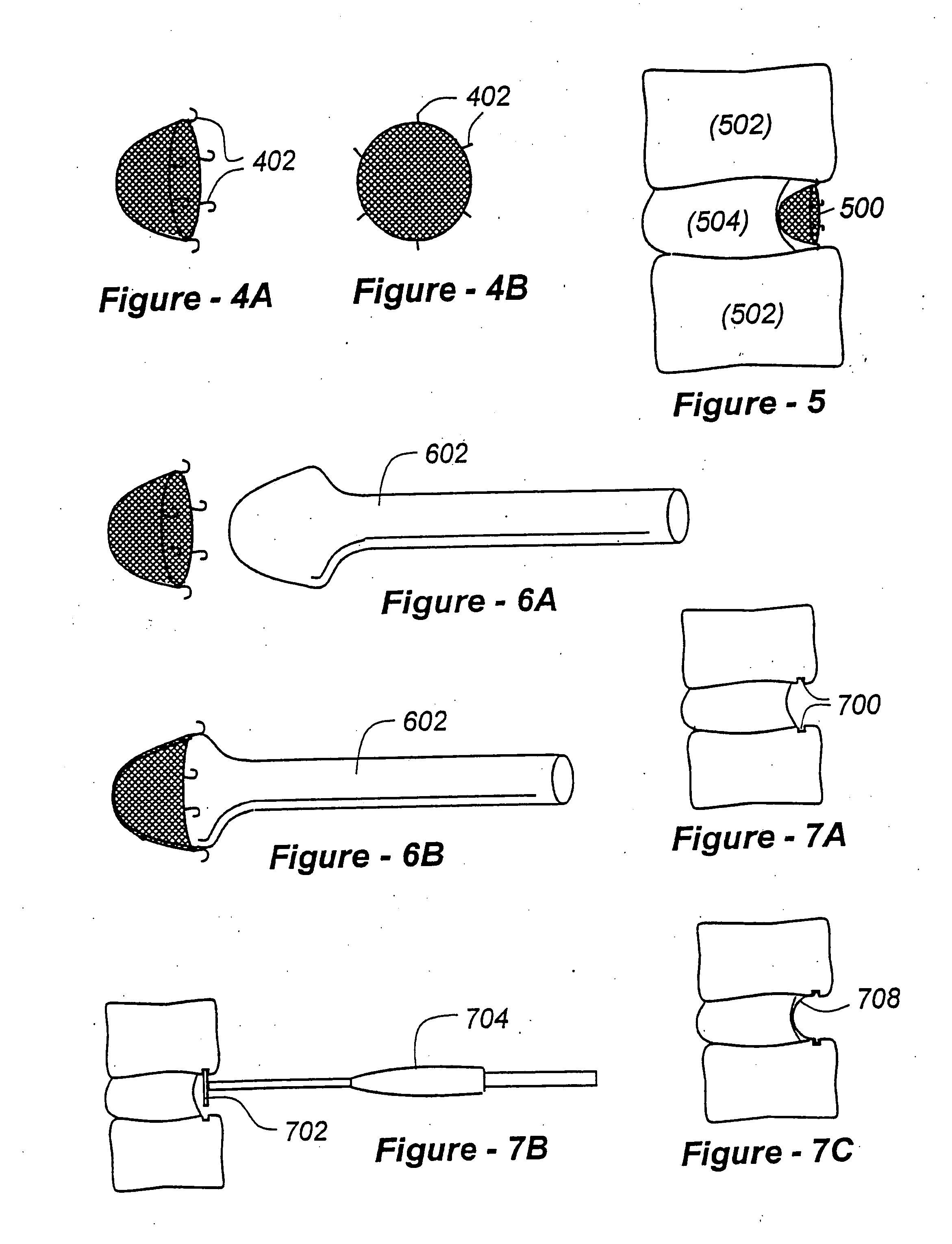 Methods for treating a defect in the annulus fibrosis