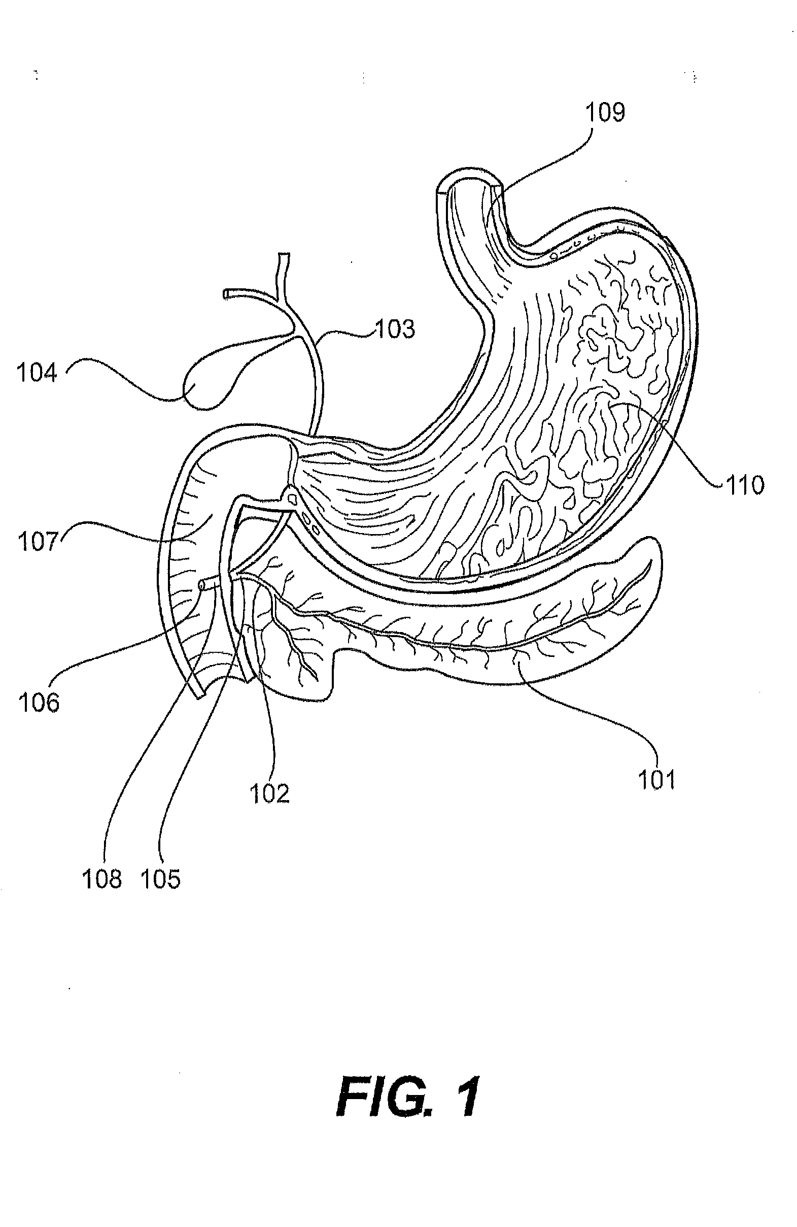 Dual lumen pancreaticobiliary catheter and methods of cannulating the pancreaticobiliary system
