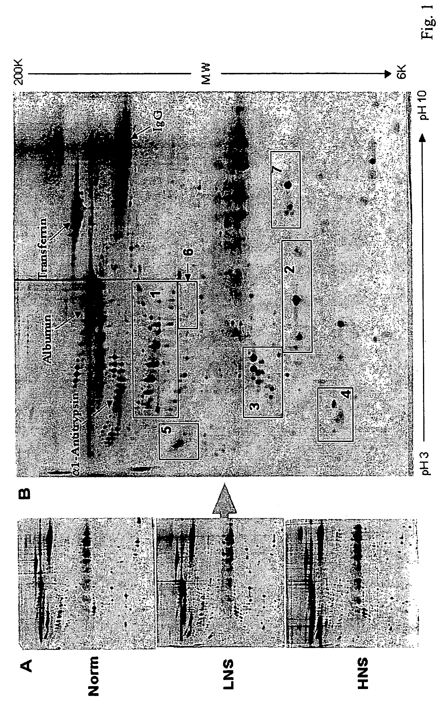 Serum biomarkers of Hepatitis B Virus infected liver and methods for detection thereof