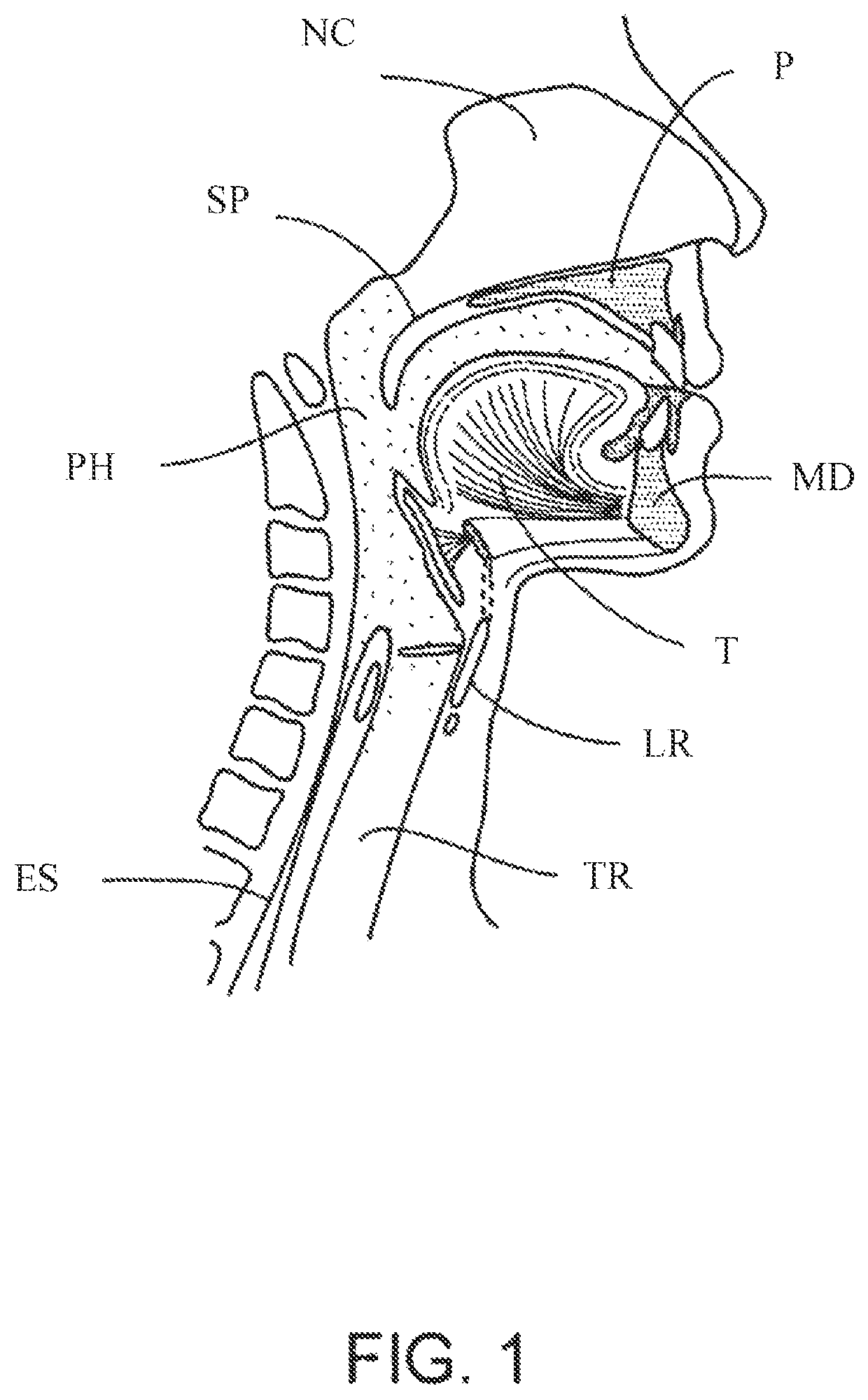 Methods and devices for treating sleep apnea and snoring