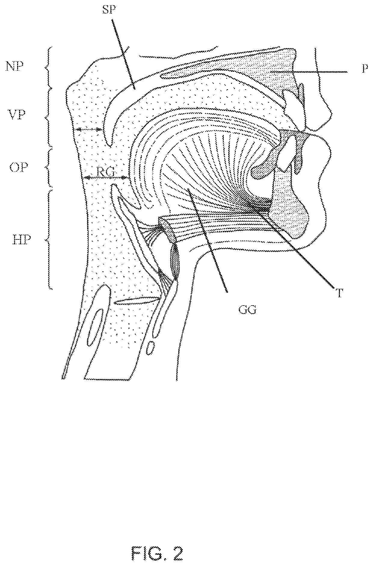 Methods and devices for treating sleep apnea and snoring