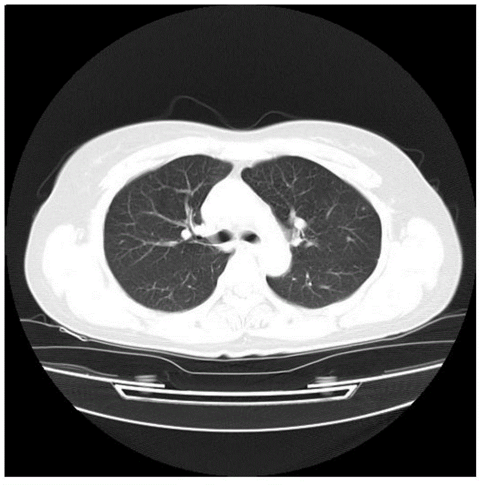 Automatic random-walk CT lung parenchyma image segmentation method based on prior information