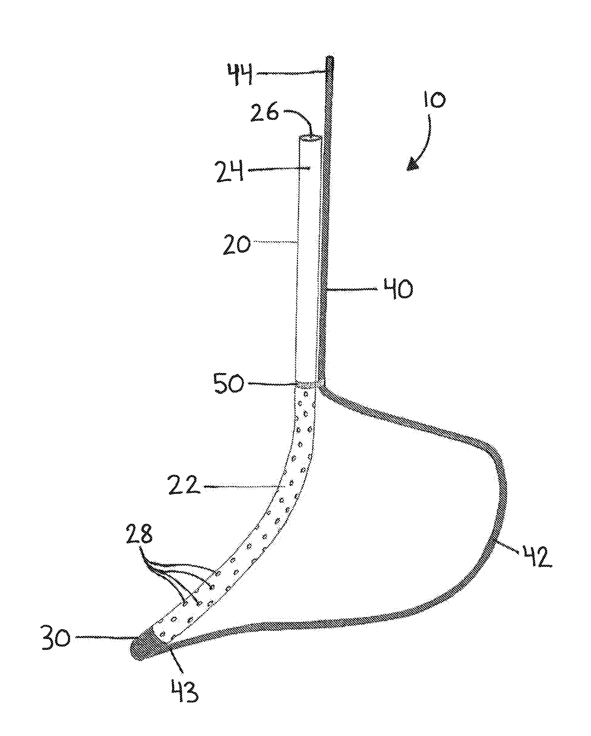 Devices and methods facilitating sleeve gastrectomy procedures