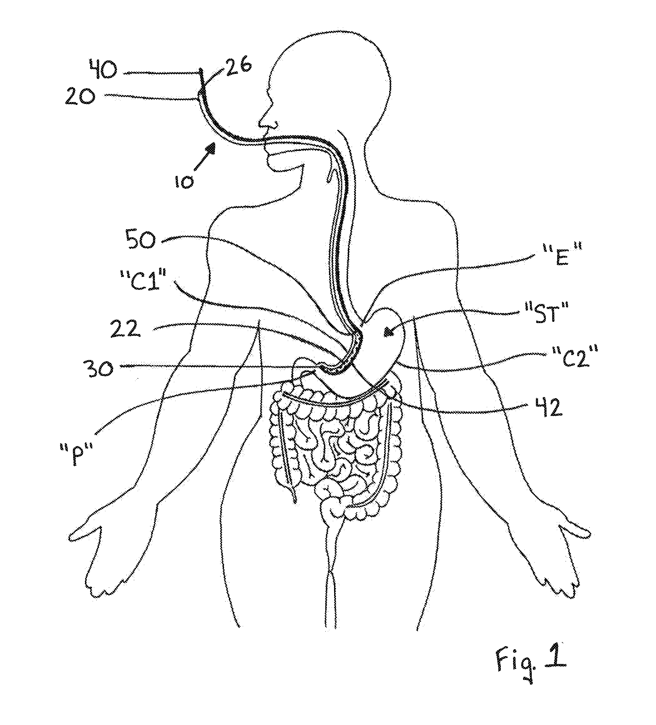 Devices and methods facilitating sleeve gastrectomy procedures