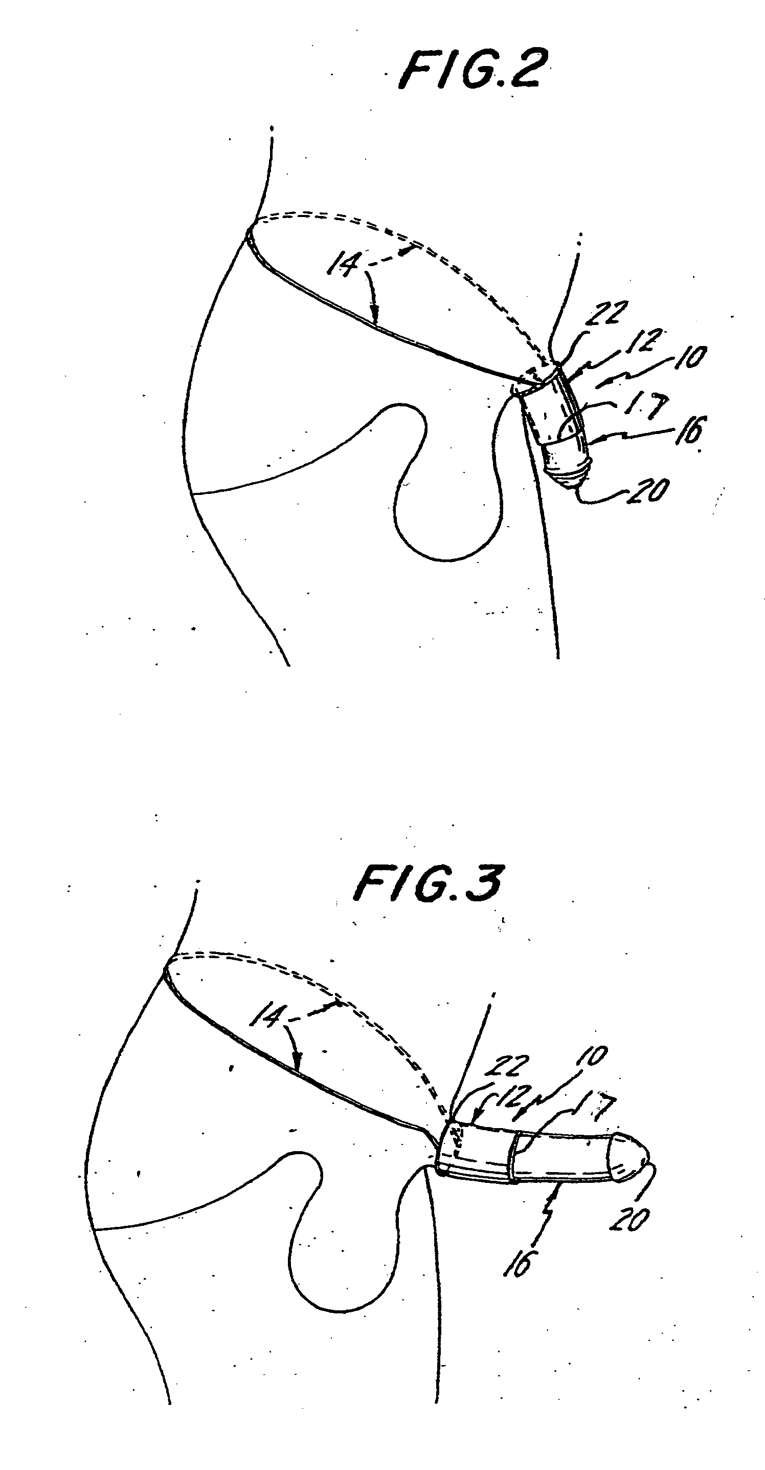Penile foreskin restraining device and method