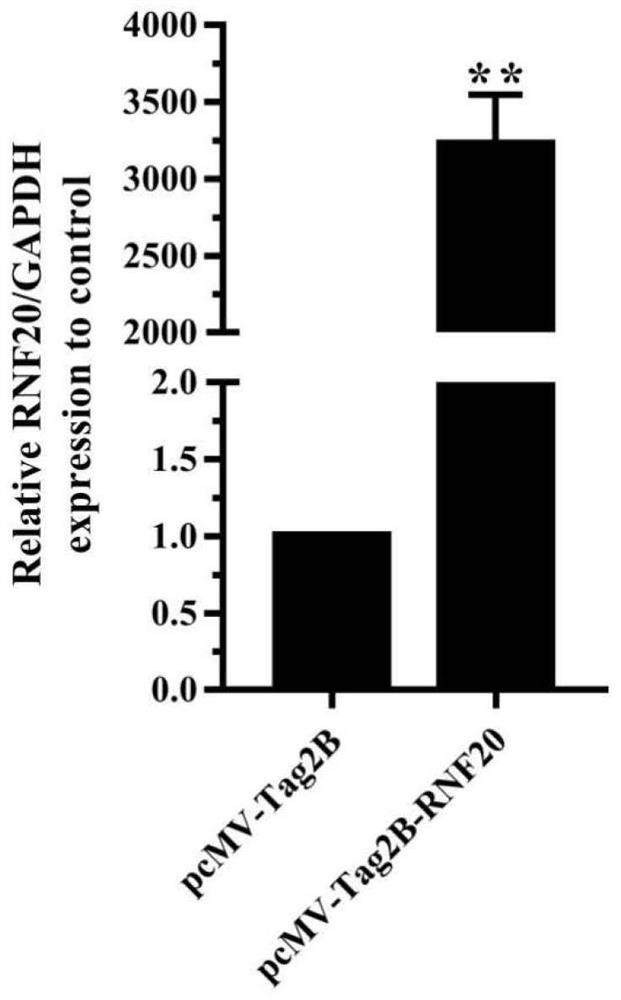 Construction of human RNF20 gene overexpression plasmid vector and effect of human RNF20 gene overexpression plasmid vector on inhibiting cancer cells