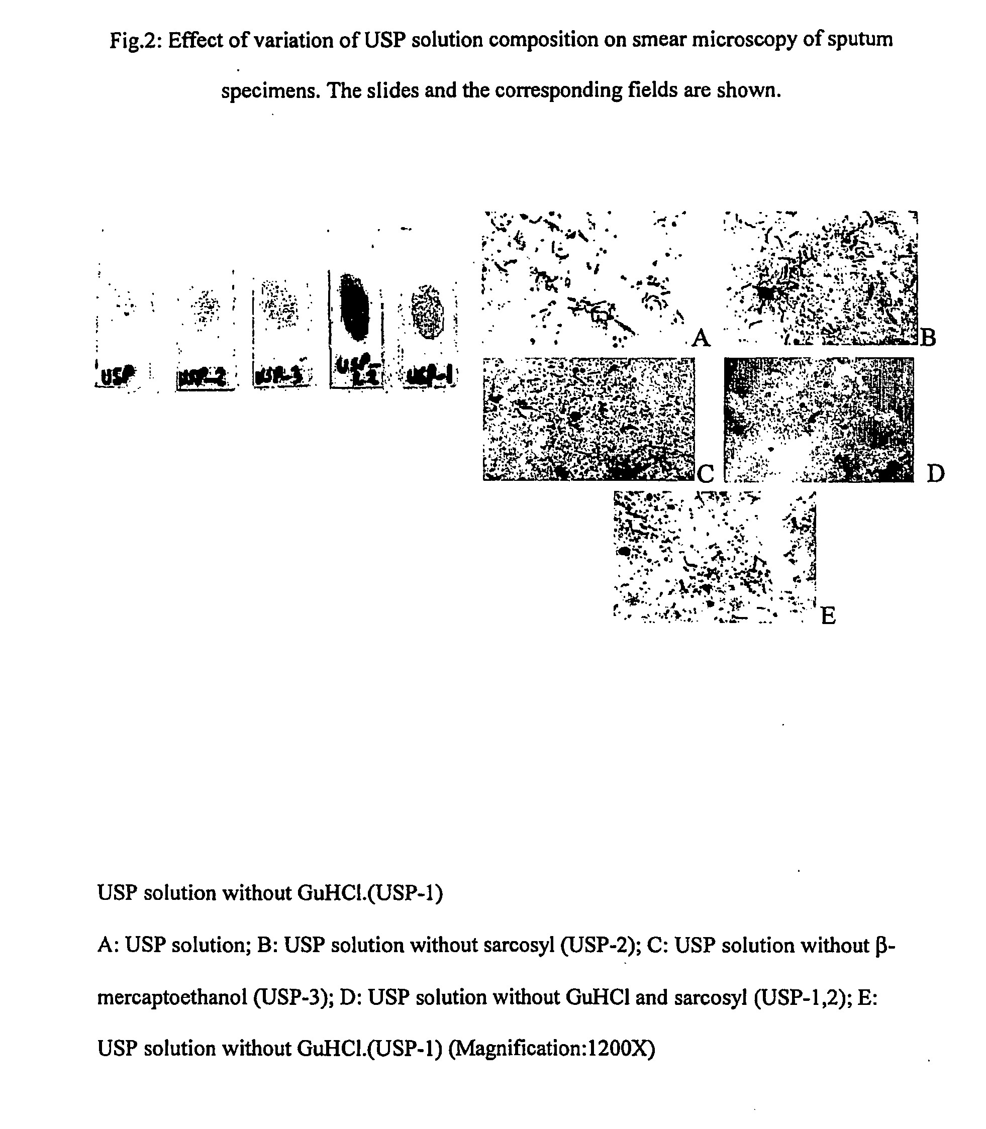 Method for diagnosis of tuberculosis by smear microscopy, culture and polymerase chain reaction using processed clinical samples and kit thereof