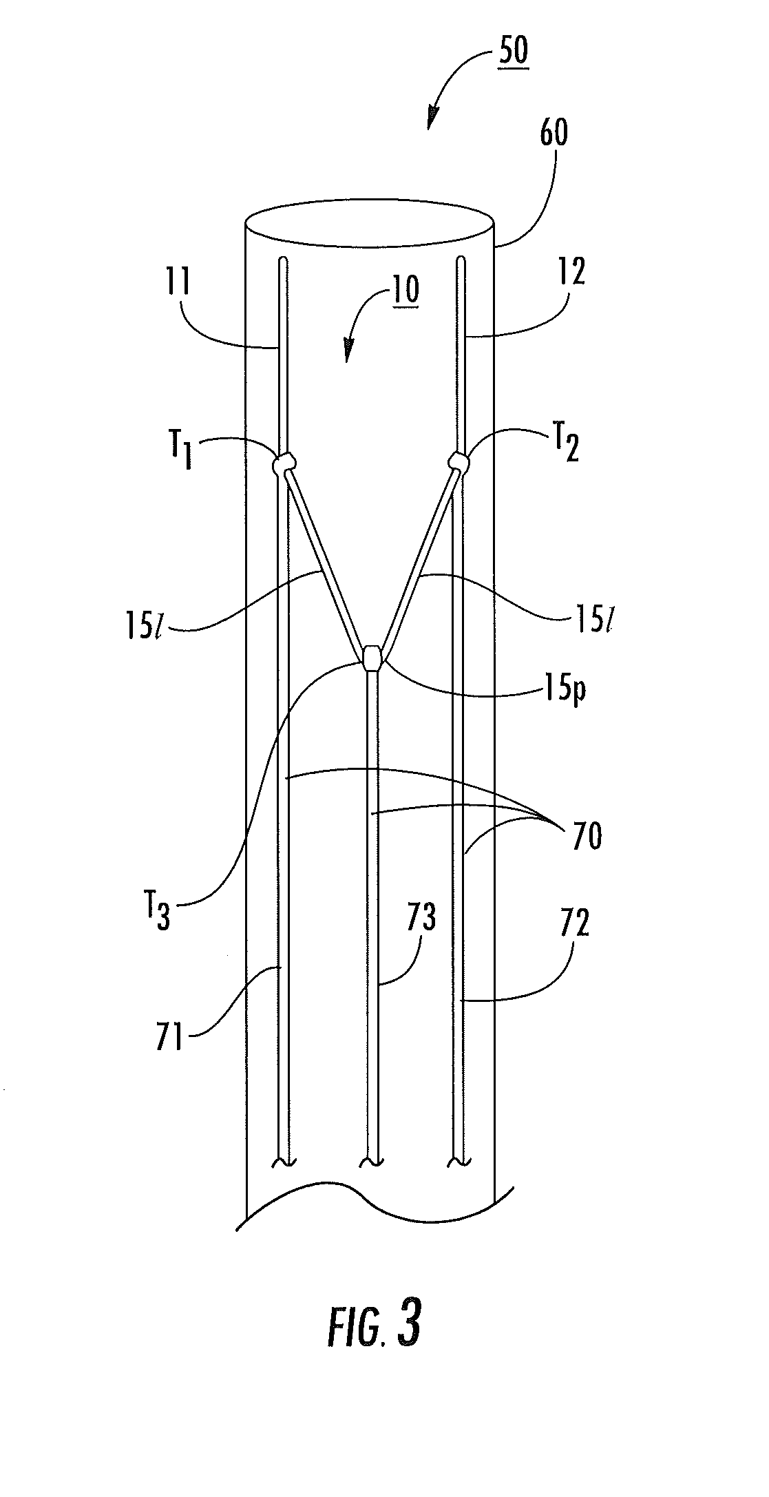 Natural orifice transluminal endoscopic devices for closure of luminal perforations and associated methods