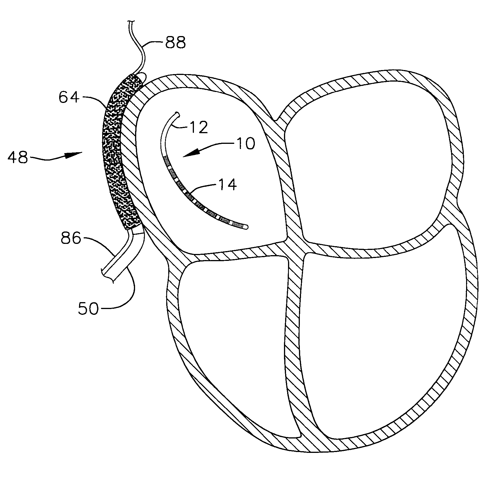 Internal indifferent electrode device for use with lesion creation apparatus and method of forming lesions using the same
