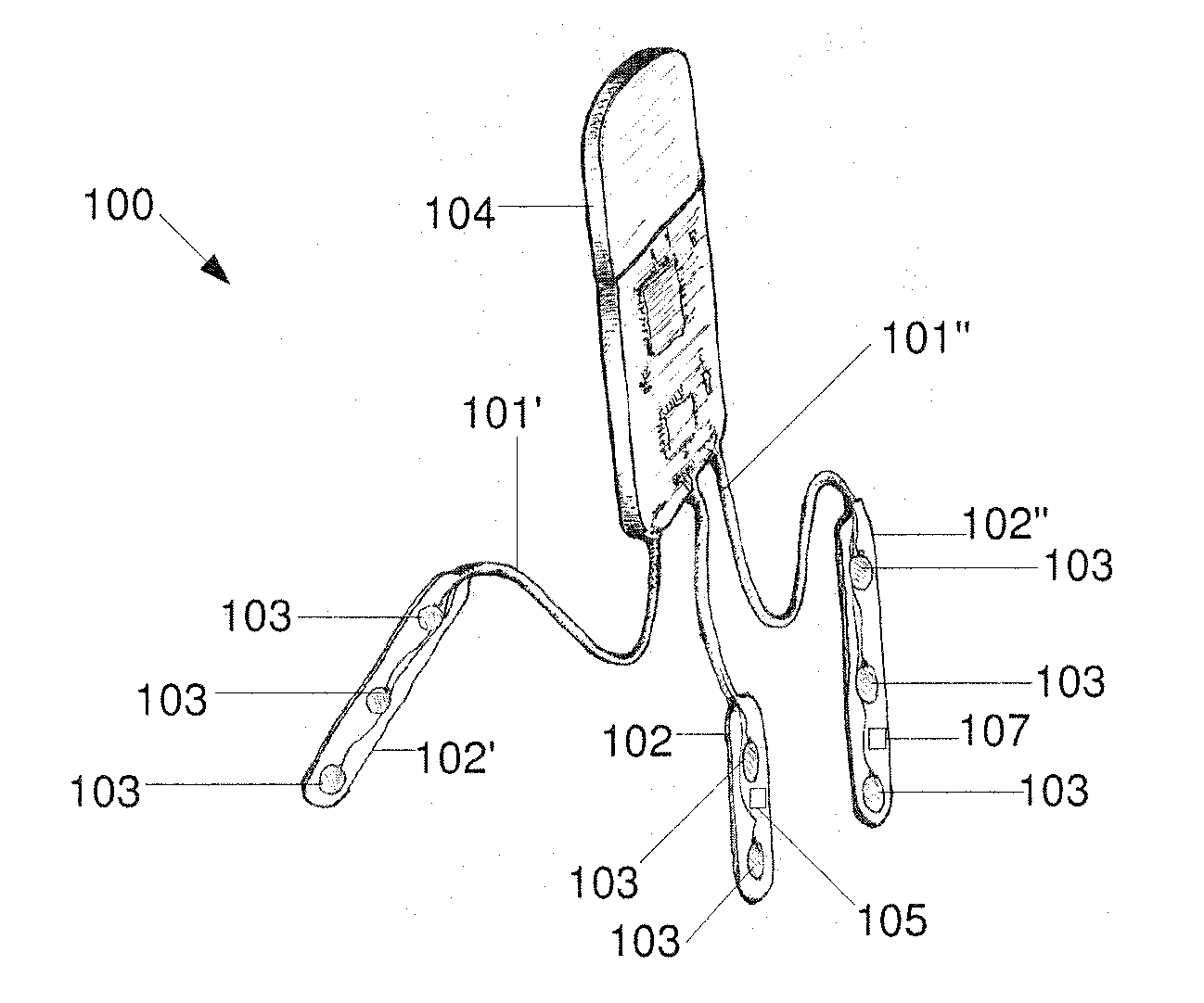 Minimally Invasive Subgaleal Extra-Cranial Electroencephalography (EEG) Monitoring Device