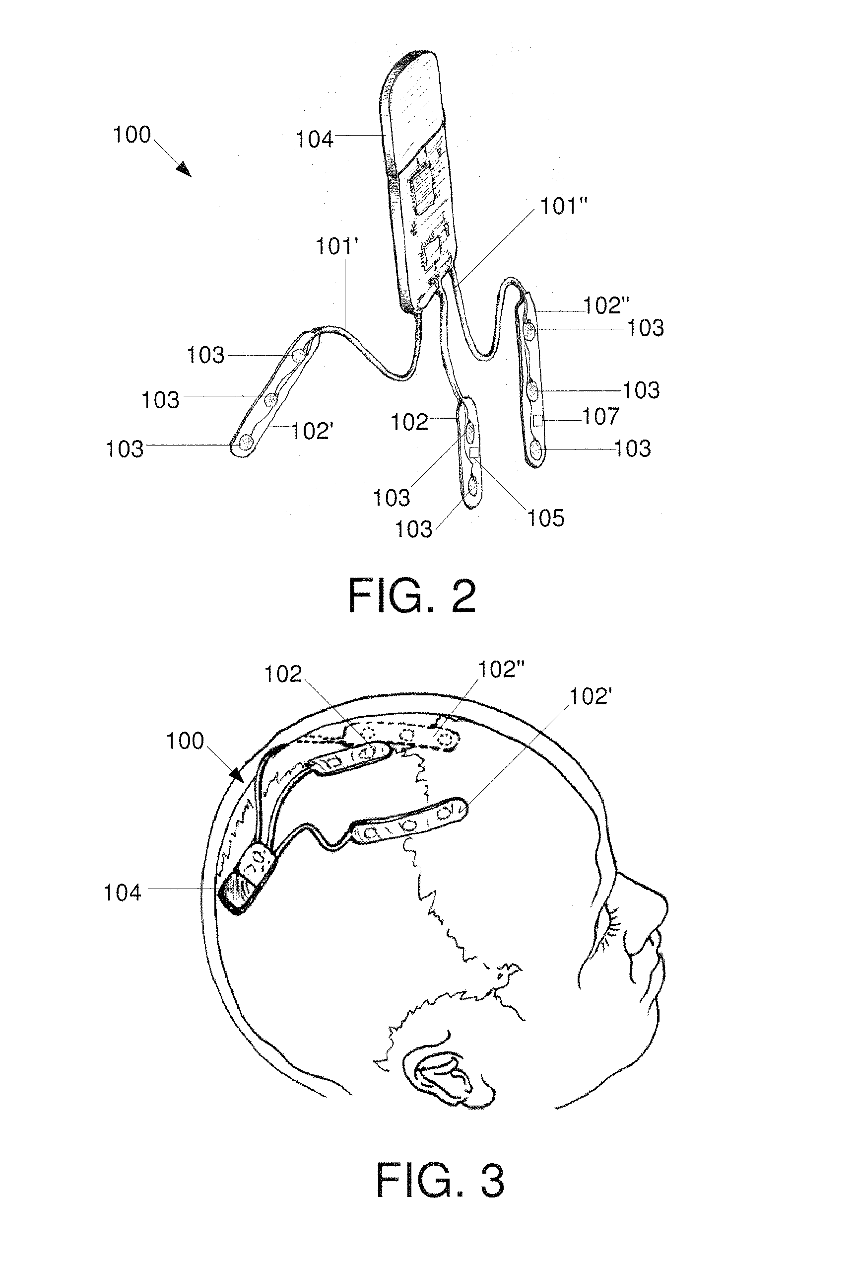 Minimally Invasive Subgaleal Extra-Cranial Electroencephalography (EEG) Monitoring Device