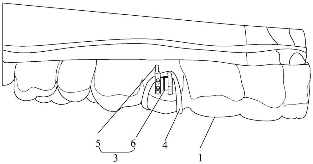 Removable residual root traction corrector and manufacturing method thereof