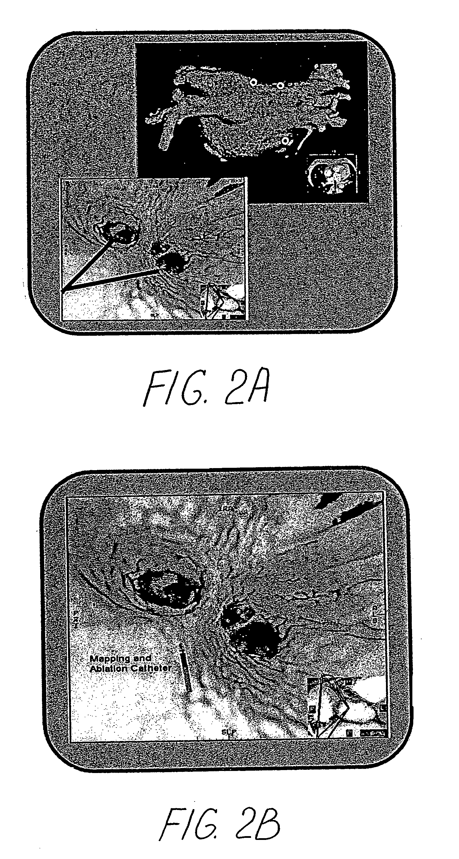 Method and system for treatment of atrial fibrillation and other cardiac arrhythmias
