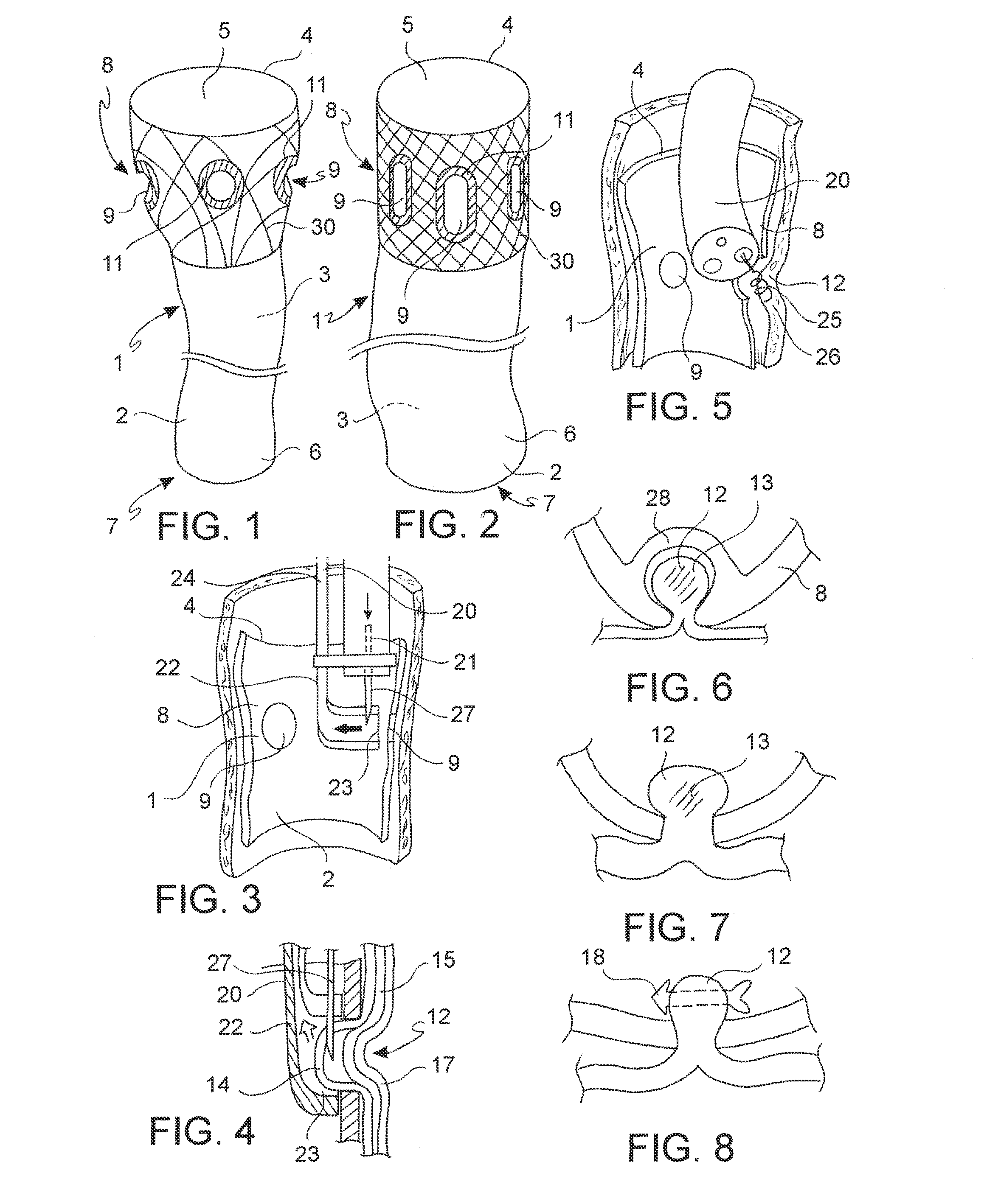 Device for Anchoring an Endoluminal Sleeve in the GI Tract