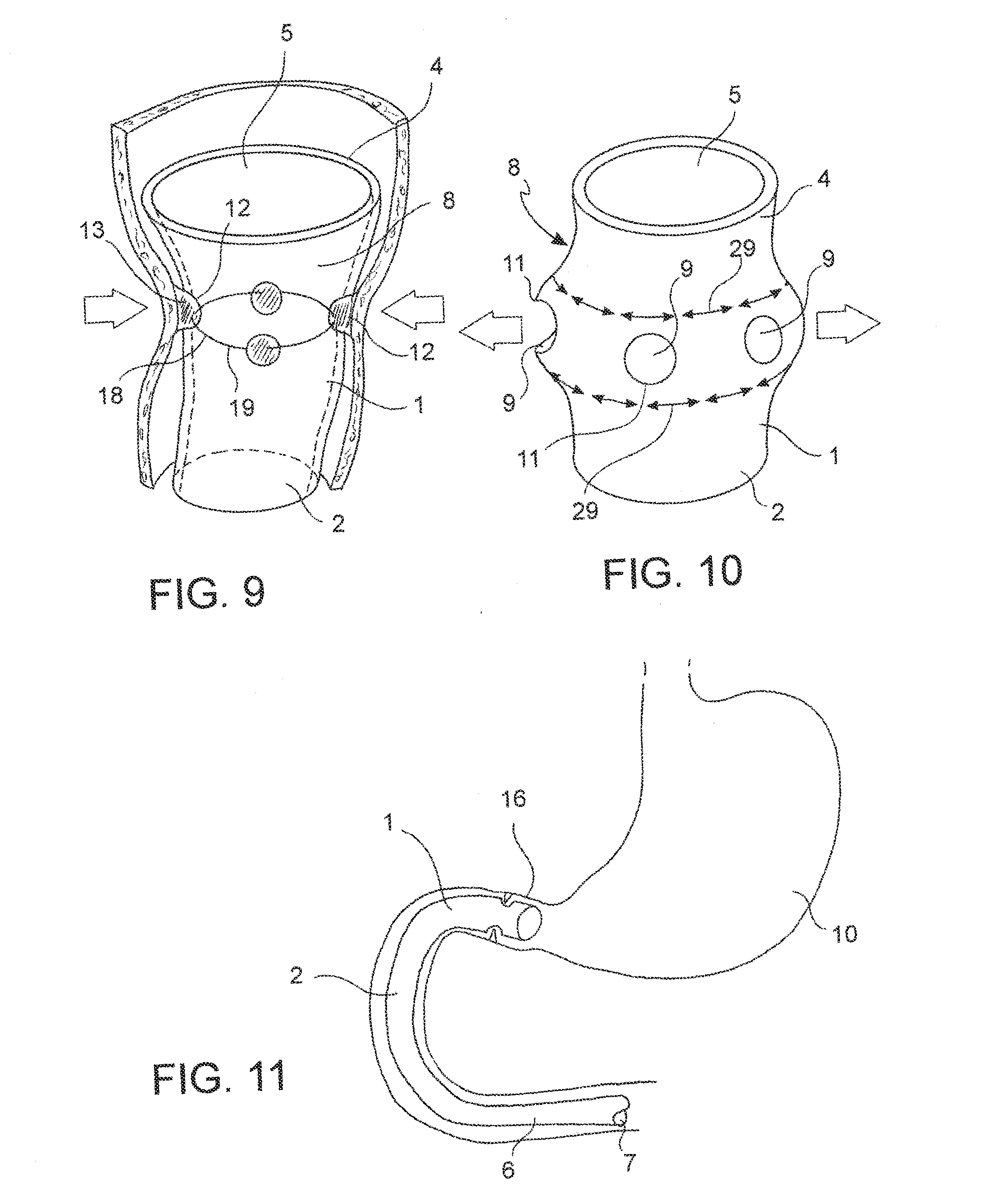 Device for Anchoring an Endoluminal Sleeve in the GI Tract