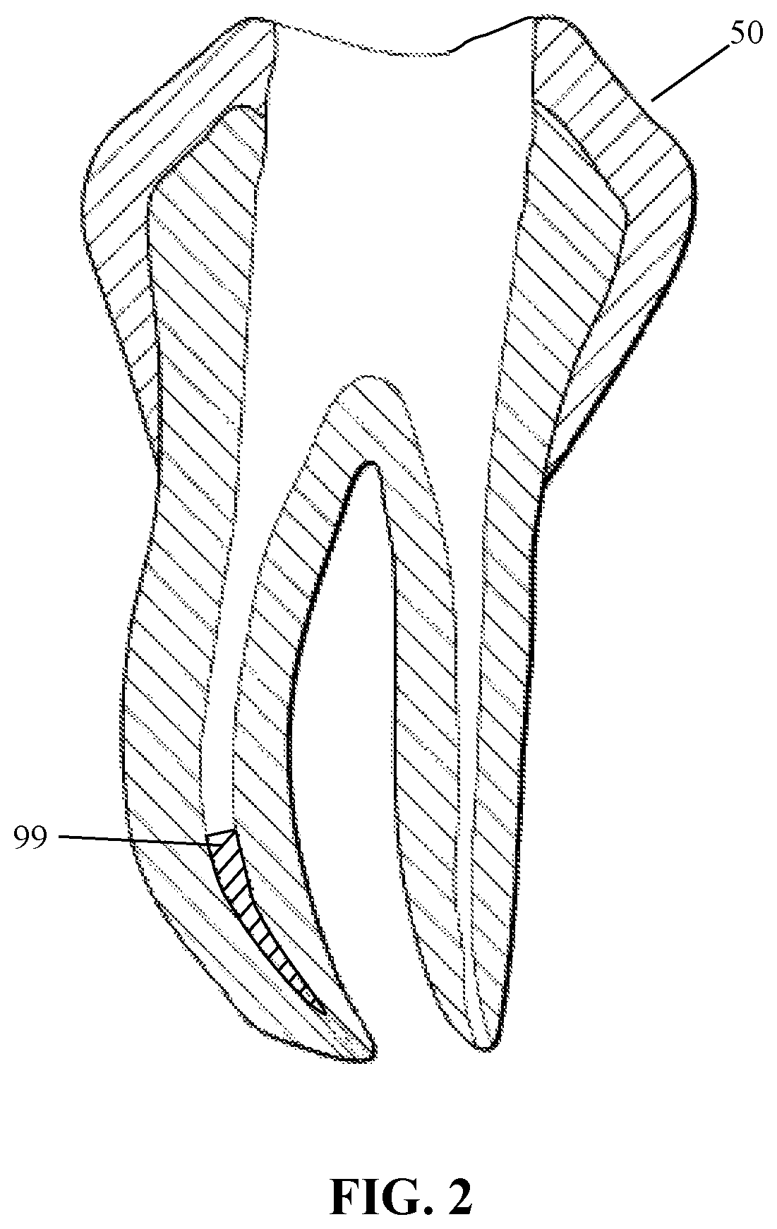Method and extraction device for removal of broken root canal file fragment