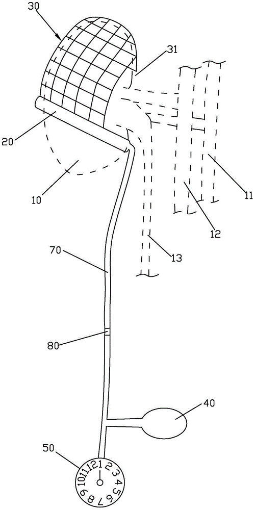 A balloon type partial renal blocker