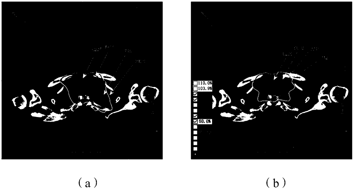 Dose optimization guided TPS (transaction per second) automatic iterative optimization algorithm