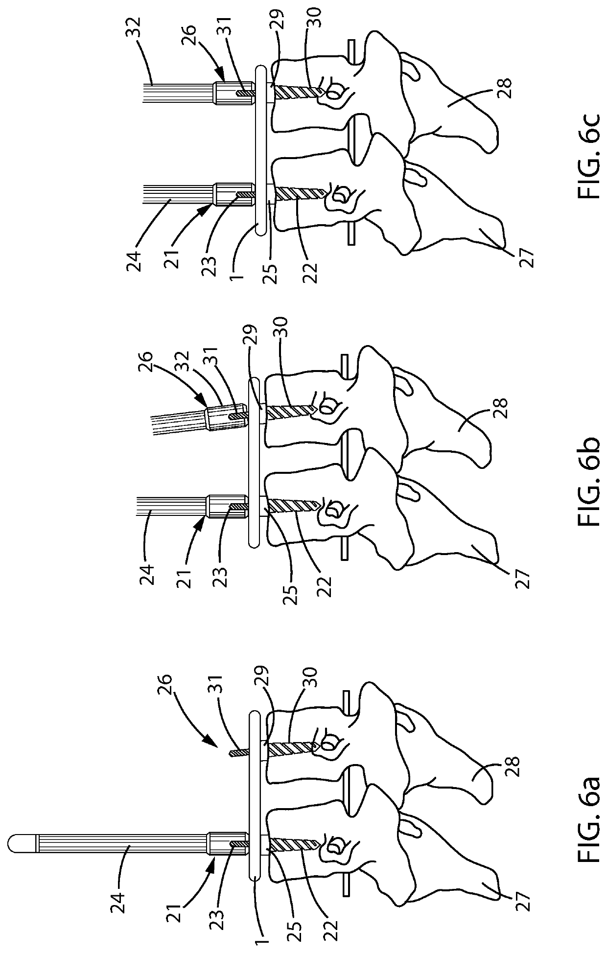 Distraction and retraction  assembly incorporating locking feature